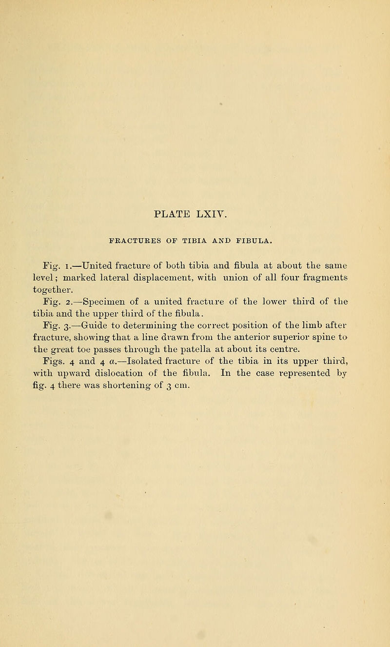 FRACTURES OF TIBIA AND FIBULA. Fig. I.—United fracture of both tibia and fibula at about the same level; marked lateral displacement, with union of all four fragments together. Fig. 2.—Specimen of a united fracture of the lower third of the tibia and the upper third of the fibula. Fig. 3.—Guide to determining the correct position of the limb after fracture, showing that a line drawn from the anterior superior spine to the great toe passes through the patella at about its centre. Figs. 4 and 4 a.—Isolated fracture of the tibia in its upper third, with upward dislocation of the fibula. In the case i-epresented by fig. 4 there was shortening of 3 cm.