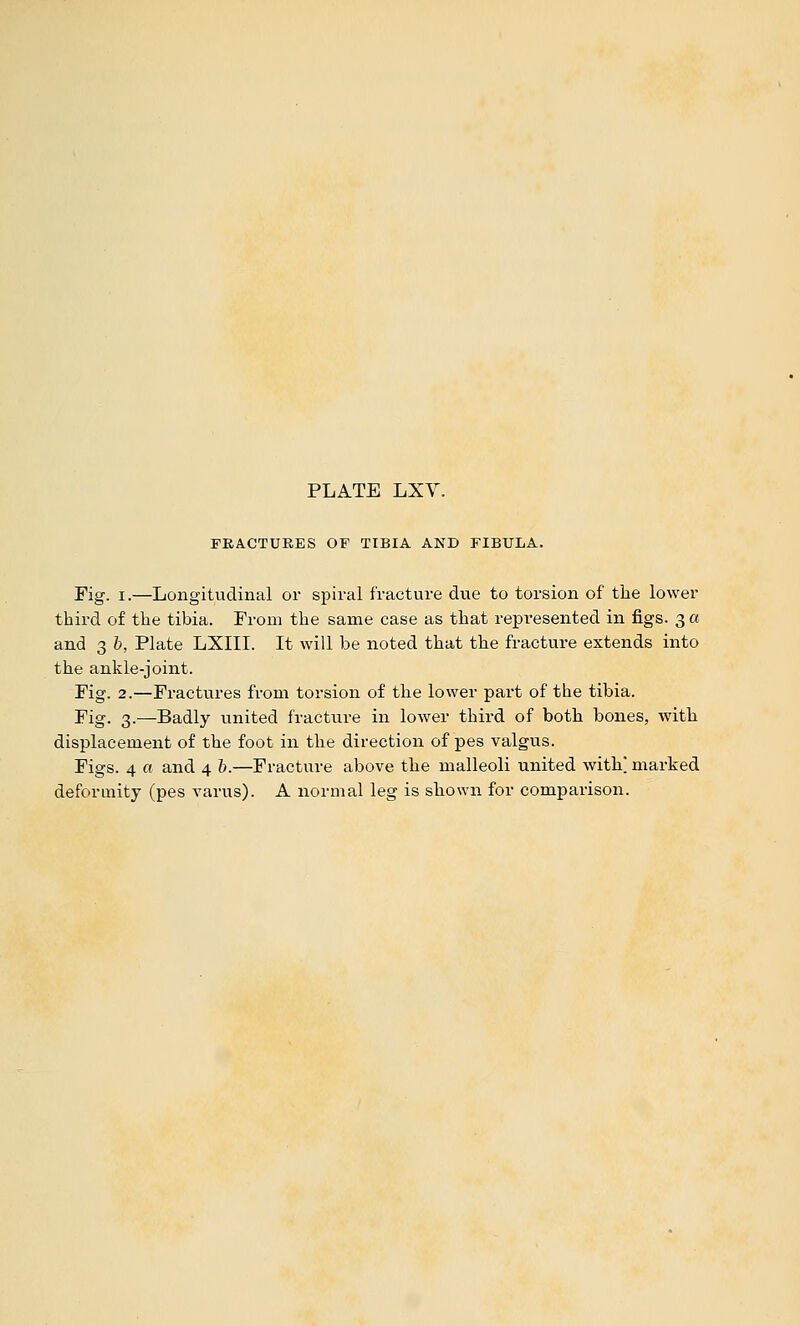 FBACTUKES OF TIBIA AND FIBULA. rig. I.—Longitudinal or spiral fracture dvie to torsion of tlie lower third of the tibia. From the same case as that represented in figs. 3 a and 3 b, Plate LXIII. It will be noted that the fracture extends into the ankle-joint. Fig. 2.—Fractures from torsion of the lower part of the tibia. Fig. 3.—Badly united fracture in lower third of both bones, witb displacement of the foot in the direction of pes valgus. Figs. 4 a and 4 b.—Fracture above the malleoli united with] marked deformity (pes varus). A normal leg is shown for comparison.