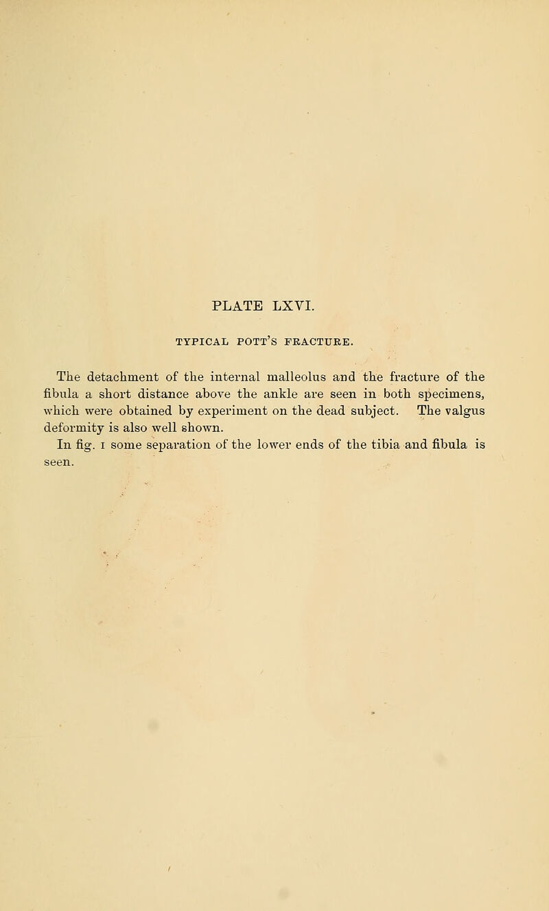 TYPICAL pott's FRACTURE. The detachment of the internal malleolus and the fracture of the fibula a short distance above the ankle are seen in both specimens, which were obtained by experiment on the dead subject. The valgus deformity is also well shown. In fig. I some separation of the lower ends of the tibia and fibula is seen.