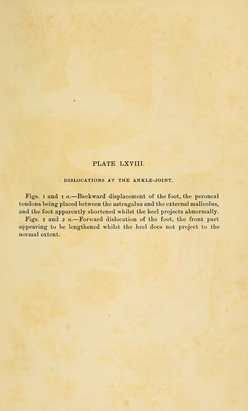 PLATE LXVIII. DISLOCATIONS Al THE ANKLE-JOINT. Figs. I and i a.—Backward displacement of the foot, the peroneal tendons being placed between the astragalus and the external malleolus, and the foot apparently shortened whilst the heel projects abnormally. Figs. 2 and 2 a.—For\/ard dislocation of the foot, the front part appearing to be lengthened whilst the heel does not project to the normal extent.