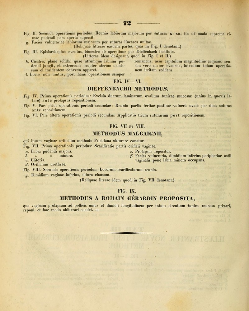 »2 Fig. II. Seonnda ojierationis porioilus: Rcunio labiorum majoriiin pcr suturas x-xn, ila ut modo siijircma ri- mae pndendi para aperta superdt. g. Facics vulucrariac labiorum liiajorum per suturas linearcs unitac. (Rcliijuac lilterac easdem jiarles, quas in Fig. I tlcnolanl.) Fig. III. Ejiisiorrhaphes eveutus. biincstic ab operatione per DieJFenbach insliluta. (Litterae idem designant, quod in Fig. I ct II.) A. Cicatrix jilanc solida. quae iilriiiuque Iabinm jtu- rcmancns, acus capitulum magniliidinc acquans, scn- dcndi jungit, el extrorsnm propter utcruni demis- sim vcro major cvadcns, intcrdum lolaiu ojicratio- sum ci insideiitem convexa apjiarct. nem irritam rcddcns. ('. Locns non iiuitus, post hauc ojieralionem sempcr FIG. IV —VI. DfEFFENBACHIt 3IETIIODUS. Fig. IV. Prima ojierationis periodus: Excisio duarum laminarum ovalium tmiicac mucosac (unius in quovis la- tere) antc prolapsus rejiosilioncm. Fig. V. Pars prior operationis periodi secundac: Reunio partis tcrtiac jiosticac vulneris ovalis pcr duas suluras ante icjiositiouem. Fig. VI. Pars altera opcrationis periodi secundae: Applicalio trium suturarum post reposilioncm. FIG. VII et VIII. 3IETHODITS 31 ALGAIGi\H, qui ijisum vaginac orificium metbodo Frickiana oblurarc conalur. Fig. VII. Piima operationis periodus: Scarificalio parlis orificii vaginae. a. Labia pudendi majora. e. Prolapsus repositus. b. » » miuora. f. Facies vulneraria, dimidium infcrius periphcriae ostii c. Clitoris. vaginalis pone labia miuora occupans. d. Orificium urethrae. Fig. VIII. Secunda operalionis pcriodus: Locorum scarificatorum reunio. g. Dimidium vaginae inferius, sutura clausum. (Reliquae litcrae idcm quod in Fig. VII denolant.) FIG. IX. 3IETIIODUS A ROMAL\ GERARDIN PROPOSITA, qua vaginam prolapsam ad pollicis unius et dimidii longitudinem per totum circuitum tunica mucosa privari, reponi. et boc modo obliterari suadet. —