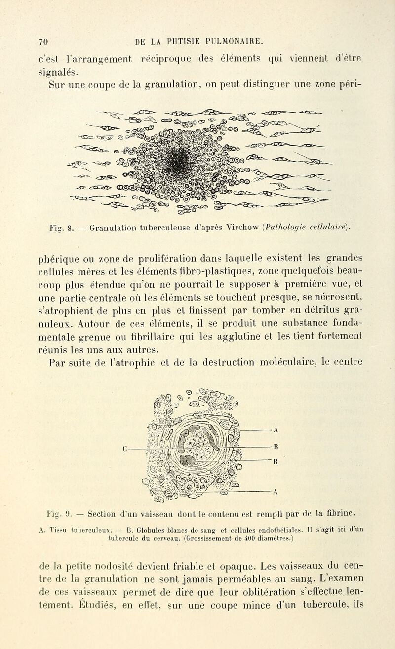 c'esl l'arrangement réciproque des éléments qui viennent d'être signalés. Sur une coupe de la granulation, on peut distinguer une zone péri- ^r^^ m Fig. 8. — Granulation tuberculeuse d'après Virchow {Pathologie cellulaire). phérique ou zone de prolifération dans laquelle existent les grandes cellules mères et les éléments fibro-plastiques, zone quelquefois beau- coup plus étendue qu'on ne pourrait le supposer à première vue, et une partie centrale où les éléments se touchent presque, se nécrosent, s'atrophient de plus en plus et finissent par tomber en détritus gra- nuleux. Autour de ces éléments, il se produit une substance fonda- mentale grenue ou fîbrillaire qui les agglutine et les tient fortement réunis les uns aux autres. Par suite de l'atrophie et de la destruction moléculaire, le centre Fig. 9. — Sectiou d'un vaisseau dont le contenu est rempli par de la fibrine. A. Tissu tuberculeux. — B. Globules blancs de sang et cellules endothéliales. 11 s'agit ici d'un tubercule du cerveau. (Grossissement de 400 diamètres.) de la petite nodosité devient friable et opaque. Les vaisseaux du cen- tre de la granulation ne sont jamais perméables au sang. L'examen de ces vaisseaux permet de dire que leur oblitération s'effectue len- tement. Etudiés, en effet, sur une coupe mince d'un tubercule, ils
