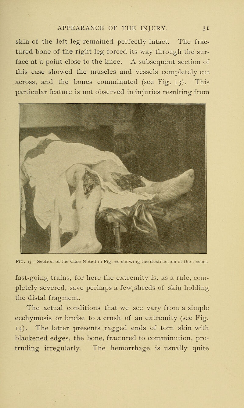 skin of the left leg remained perfectly intact. The frac- tured bone of the right leg forced its way through the sur- face at a point close to the knee. A subsequent section of this case showed the muscles and vessels completely cut across, and the bones comminuted (see Fig. 13). This particular feature is not observed in injuries resulting from FIG. 13.—Section of the Case Noted in Fig. 12, showing the destruction of the tissues. fast-going trains, for here the extremity is, as a rule, com- pletely severed, save perhaps a fe w^ shreds of skin holding the distal fragment. The actual conditions that we see vary from a simple ecchymosis or bruise to a crush of an extremity (see Fig. 14). The latter presents ragged ends of torn skin with blackened edges, the bone, fractured to comminution, pro- truding irregularly. The hemorrhage is usually quite