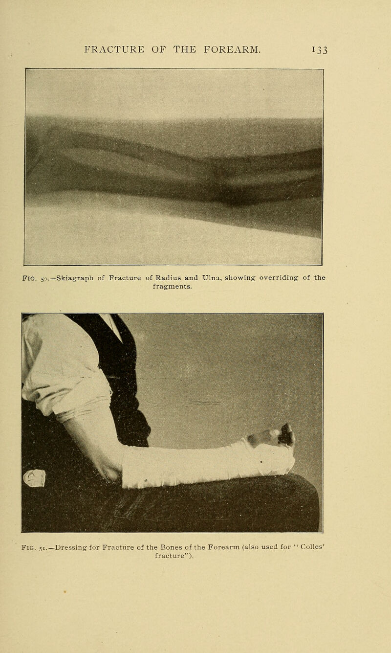 FlG. 50.—Skiagraph of Fracture of Radius and Ulna, showing' overriding- of the fragments. FIG. 51.—Dressing for Fracture of the Bones of the Forearm (also used for  Colles' fracture).