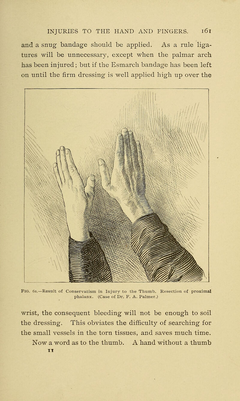 and a snug bandage should be applied. As a rule liga- tures will be unnecessary, except when the palmar arch has been injured; but if the Esmarch bandage has been left on until the firm dressing is well applied high up over the Fig. 62.—Result of Conservatism in Injury to the Thumb. Resection of proximal phalanx. (Case of Dr. F. A. Palmer.) wrist, the consequent bleeding will not be enough to soil the dressing. This obviates the difficulty of searching for the small vessels in the torn tissues, and saves much time. Now a word as to the thumb. A hand without a thumb 11