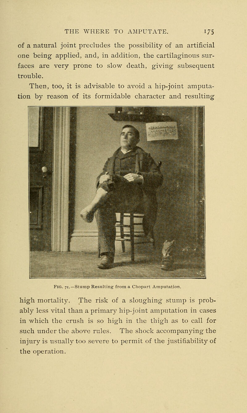 of a natural joint precludes the possibility of an artificial one being applied, and, in addition, the cartilaginous sur- faces are very prone to slow death, giving subsequent trouble. Then, too, it is advisable to avoid a hip-joint amputa- tion by reason of its formidable character and resulting Fig. 71. —Stump Resulting from a Chopart Amputation. high mortality. The risk of a sloughing stump is prob- ably less vital than a primary hip-joint amputation in cases in which the crush is so high in the thigh as to call for such under the above rules. The shock accompanying the injury is usually too severe to permit of the justiBability of the operation.