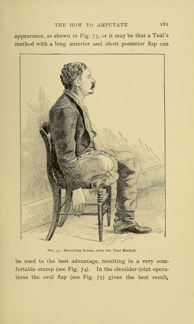 appearance, as shown in Fig. 73, or it may be that a Teal's method with a long anterior and short posterior flap can Fig. 74.—Resulting Stump after the Teal Method. be used to the best advantage, resulting in a very com- fortable stump (see Fig. 74). In the shoulder-joint opera- tions the oval flap (see Fig. 75) gives the best result,