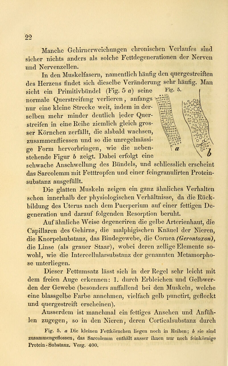 Manche Gehirnenveicliungen clironisclien Verlaufes sind sicher nichts anders als solche Fettdegenerationen der Nerven und Nervenzellen. In den Muskelfasern, namentlich häufig den quergestreiften des Herzens findet sich dieselbe Veränderung sehr häufig. Man sieht ein Primitivbündel (Fig. 5 a) seine Fig. 5. normale Querstreifung verlieren, anfangs nur eine kleine Strecke weit, indem in der- selben mehr minder deutlich ieder Quer- streifen in eine Reihe ziemlich gleich gros- ser Körnchen zerfällt, die alsbald wachsen, zusammenfliessen und so die unregelmässi- ge Form hei-vorbringen, wie die neben- stehende Figur 6 zeigt. Dabei erfolgt eine schwache Anschwellung des Bündels, und schliesslich erscheint das Sarcolemm mit Fetttropfen und einer feingranulirten Protein- substanz ausgefüllt. Die glatten Muskeln zeigen ein ganz ähnliches Verhalten schon innerhalb der physiologischen Verhältnisse, da die Rück- bildung des Uterus nach dem Puerperium auf einer fettigen De- generation und darauf folgenden Resorption beruht. Auf ähnliche Weise degeneriren die gelbe Arterienhaut, die Capillaren des Gehirns, die malphigischen Knäuel der Nieren, die Knorpelsubstanz, das Bindegewebe, die Cornea (Gerontoxon), die Linse (als grauer Staar), wobei deren zellige Elemente so- wohl, wie die Intercellularsubstanz der genannten Metamorpho- se unterliegen. Dieser Fettumsatz lässt sich in der Regel sehr leicht mit dem freien Auge erkennen: 1. durch Erbleichen und Gelbwer- den der Gewebe (besonders aufiallend bei den Muskeln, welche eine blassgelbe Farbe annehmen, vielfach gelb punctirt, gefleckt und quergestreift erscheinen). Ausserdem ist manchmal ein fettiges Ansehen und Anfüh- len zugegen, so in den Nieren, deren Corticalsubstanz durch Fig. 5. a Die kleinen Fettkörnchen liegen noch in Keüien; b sie sind zusammengeflossen, das Sarcolemm enthält ausser ihnen mu* noch feinkörnige Protein - Substanz. Verg. 400.