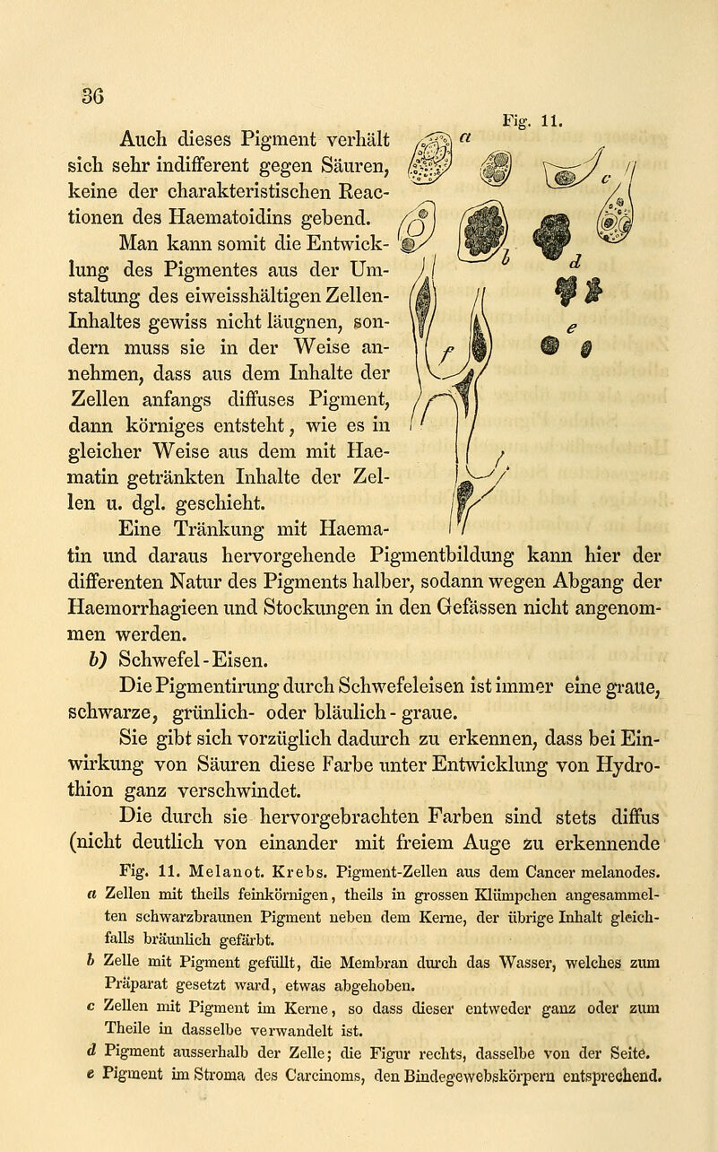 Auch dieses Pigment verhält sich sehr indifferent gegen Säuren, keine der charakteristischen Reac- tionen des Haematoidins gebend. /^ Man kann somit die Entwick- ^ lung des Pigmentes aus der Um- staltung des eiweisshältigen Zellen- Inhaltes gewiss nicht läugnen, son- dern muss sie in der Weise an- nehmen, dass aus dem Inhalte der Zellen anfangs diffuses Pigment, dann körniges entsteht, wie es in gleicher Weise aus dem mit Hae- matin getränkten Inhalte der Zel- len u. dgl. geschieht. Eine Tränkung mit Haema- tin und daraus hervorgehende Pigmentbildung kann hier der differenten Natur des Pigments halber, sodann wegen Abgang der Haemorrhagieen und Stockungen in den Gefässen nicht angenom- men werden. b) Schwefel-Eisen. Die Pigmentirung durch Schwefelelsen ist immer eine graue, schwarze, grünlich- oder bläulich - graue. Sie gibt sich vorzüglich dadurch zu erkennen, dass bei Ein- wirkung von Säuren diese Farbe unter Entwicklung von Hydro- thion ganz verschwindet. Die durch sie hervorgebrachten Farben sind stets diffus (nicht deutlich von einander mit freiem Auge zu erkennende Fig. 11. Melanot. Krebs. Pigment-Zellen aus dem Cancer melanodes. a Zellen mit tlieils feinkörnigen, theils in gi-ossen Klümpchen angesammel- ten schwarzbraunen Pigment neben dem Kerne, der übrige Inhalt gleich- falls bräunlich gefärbt. h Zelle mit Pigment gefüllt, die Membran durch das Wasser, welches zum Präparat gesetzt ward, etwas abgehoben. c Zellen mit Pigment im Kerne, so dass dieser entweder ganz oder zum Theile in dasselbe verwandelt ist. d Pigment ausserhalb der Zelle; die Figur rechts, dasselbe von der Seite. e Pigment im Stroma des Carcinoms, den Biudegewebskörpern entsprechend.