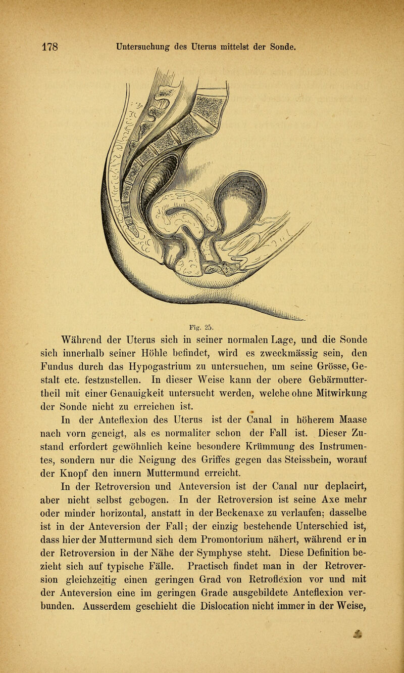 Fig. 25. Während der Uterus sich in seiner normalen Lage, und die Sonde sich innerhalb seiner Höhle befindet, wird es zweckmässig sein, den Fundus durch das Hypogastrium zu untersuchen, um seine Grösse, Ge- stalt etc. festzustellen. In dieser Weise kann der obere Gebärmutter- theil mit einer Genauigkeit untersucht werden, welche ohne Mitwirkung der Sonde nicht zu erreichen ist. In der Anteflexion des Uterus ist der Canal in höherem Maase nach vorn geneigt, als es normaliter schon der Fall ist. Dieser Zu- stand erfordert gewöhnlich keine besondere Krümmung des Instrumen- tes, sondern nur die Neigung des Griffes gegen das Steissbein, worauf der Knopf den innern Muttermund erreicht. In der Retroversion und Anteversion ist der Canal nur deplacirt, aber nicht selbst gebogen. In der Retroversion ist seine Axe mehr oder minder horizontal, anstatt in der Beckenaxe zu verlaufen; dasselbe ist in der Anteversion der Fall; der einzig bestehende Unterschied ist, dass hier der Muttermund sich dem Promontorium nähert, während er in der Retroversion in der Nähe der Symphyse steht. Diese Definition be- zieht sich auf typische Fälle. Practisch findet man in der Retrover- sion gleichzeitig einen geringen Grad von Retroflexion vor und mit der Anteversion eine im geringen Grade ausgebildete Anteflexion ver- bunden. Ausserdem geschieht die Dislocation nicht immer in der Weise, 4