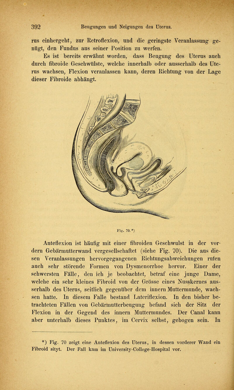 rus einhergeht, zur Retroflexion, und die geringste Veranlassung ge- nügt, den Fundus aus seiner Position zu werfen. Es ist bereits erwähnt worden, dass Beugung des Uterus auch durch fibroide Geschwülste, welche innerhalb oder ausserhalb des Ute- rus wachsen, Flexion veranlassen kann, deren Richtung von der Lage dieser Fibroide abhängt. Fig. 70.*) Anteflexion ist häufig mit einer fibroiden Geschwulst in der vor- dem Gebärmutterwand vergesellschaftet (siehe Fig. 70). Die aus die- sen Veranlassungen hervorgegangenen Richtungsabweichungen rufen auch sehr störende Formen von Dysmenorrhoe hervor. Einer der schwersten Fälle, den ich je beobachtet, betraf eine junge Dame, welche ein sehr kleines Fibroid von der Grösse eines Nusskernes aus- serhalb des Uterus, seitlich gegenüber dem innern Muttermunde, wach- sen hatte. In diesem Falle bestand Lateriflexion. In den bisher be- trachteten Fällen von Gebärmutterbeugung befand sich der Sitz der Flexion in der Gegend des innern Muttermundes. Der Canal kann aber unterhalb dieses Punktes, im Cervix selbst, gebogen sein. In *) Fig. 70 zeigt eine Anteflexion des Uterus, in dessen vorderer Wand ein Fibroid sityt. Der Fall kam im University-College-Hospital vor.