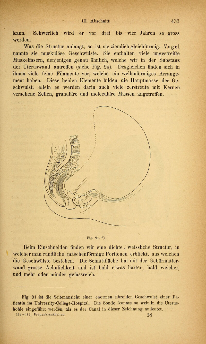 kann. Schwerlich wird er vor drei bis vier Jahren so gross werden. Was die Structur anlangt, so ist sie ziemlich gleichförmig. Vogel nannte sie muskulöse Geschwülste. Sie enthalten viele ungestreifte Muskelfasern, denjenigen genau ähnlich, welche wir in der Substanz der Uteruswand antreffen (siehe Fig. 94). Desgleichen finden sich in ihnen viele feine Filamente vor, welche ein wellenförmiges Arrange- ment haben. Diese beiden Elemente bilden die Hauptmasse der Ge- schwulst; allein es werden darin auch viele zerstreute mit Kernen versehene Zellen, granuläre und moleculäre Massen angetroffen. Fig. 91. *) Beim Einschneiden finden wir eine dichte, weissliche Structur, in welcher man rundliche, maschenförmige Portionen erblickt, aus welchen die Geschwülste bestehen. Die Schnittfläche hat mit der Gebännutter- wand grosse Aehnlichkeit und ist bald etwas härter, bald weicher, und mehr oder minder gefässreich. Fig. 91 ist die Seitenansicht einer enormen fibroiden Geschwulst einer Pa- tientin im University-College-Hospital. Die Sonde konnte so weit in die Uterus- höhle eingeführt werden, als es der Canal in dieser Zeichnung andeutet. Hewitt, Frauenkrankheiten. OW