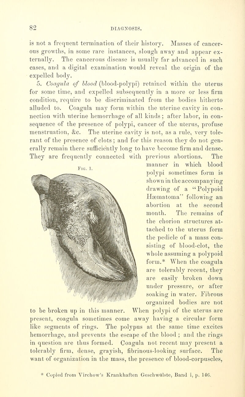 Fig. 1. is not a frequent termination of their history. Masses of cancer- ous growths, in some rare instances, slough away and appear ex- ternally. The cancerous disease is usually far advanced in such cases, and a digital examination would reveal the origin of the expelled body, 5. Coagula of blood (blood-polypi) retained Avithin the uterus for some time, and expelled subsequently in a more or less firm condition, require to be discriminated from the bodies hitherto alluded to. Coagula may form within the uterine cavity in con- nection with uterine hemorrhage of all kinds; after labor, in con- sequence of the presence of polypi, cancer of the uterus, profuse menstruation, &c. The uterine cavity is not, as a rule, very tole- rant of the presence of clots; and for this reason they do not gen- erally remain there sufficiently long to have become firm and dense. They are frequently connected with previous abortions. The manner in which blood polypi sometimes form is shown in the accompanying drawing of a Polypoid Hsematoma folloAving an abortion at the second month. The remains of the chorion structures at- tached to the uterus form the pedicle of a mass con- sisting of blood-clot, the whole assuming a polypoid form.* When the coagula are tolerably recent, they are easily broken down under pressure, or after soaking in water. Fibrous organized bodies are not to be broken up in this manner. When polypi of the uterus are present, coagula sometimes come away having a circular form like segments of rings. The polypus at the same time excites hemorrhage, and prevents the escape of the blood ; and the rings in question are thus formed. Coagula not recent may present a tolerably firm, dense, grayish, fibrinous-looking surface. The want of organization in the mass, the presence of blood-corpuscles, * Copied from Virchow's Krankhaften Geschwulste, Band i, p. 146.