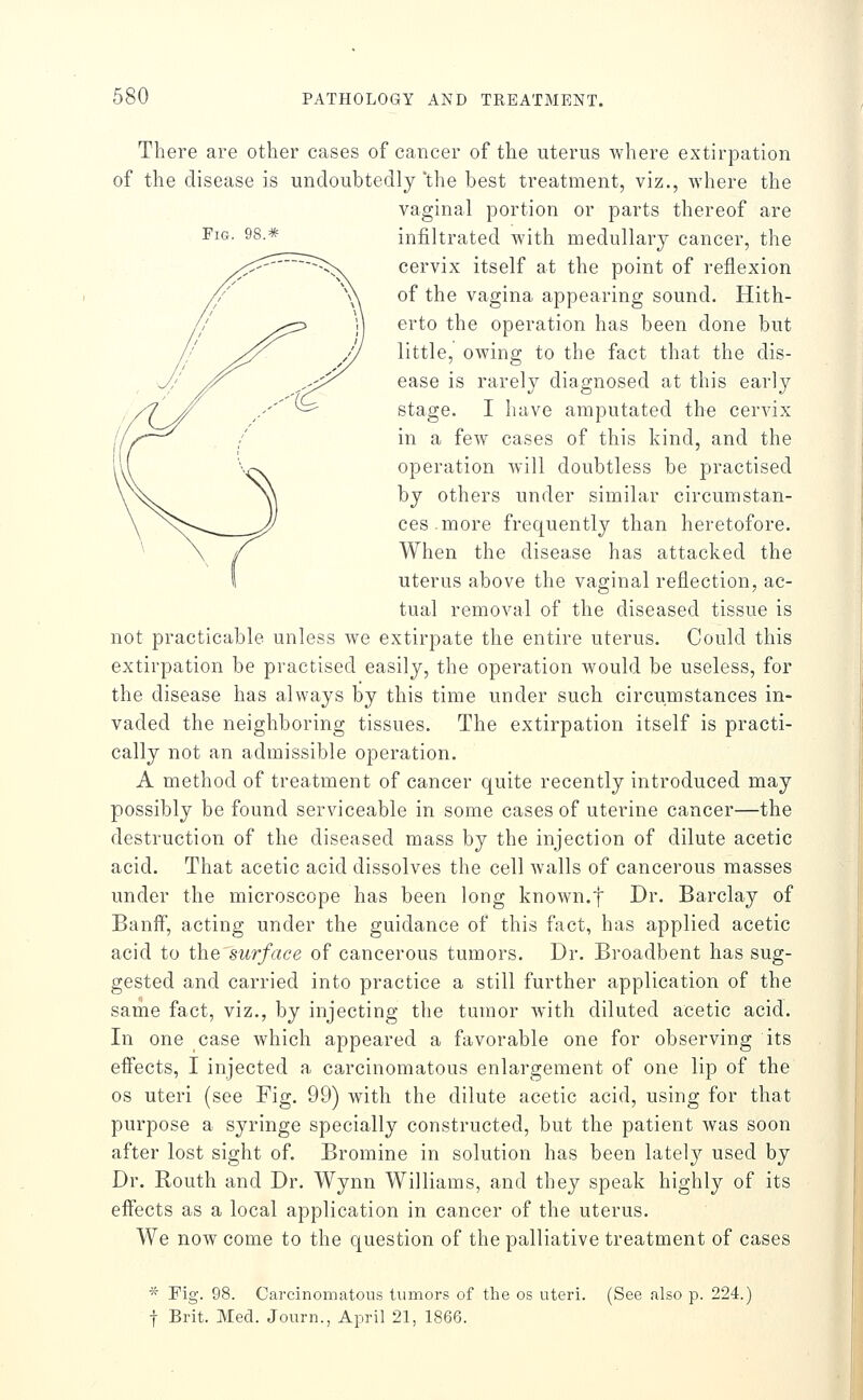 Fig. 98.* There are other cases of cancer of the uterus where extirpation of the disease is undoubtedly 'the best treatment, viz., where the vaginal portion or parts thereof are infiltrated with medullary cancer, the cervix itself at the point of reflexion of the vagina appearing sound. Hith- erto the operation has been done but little, owing to the fact that the dis- ease is rarely diagnosed at this early stage. I have amputated the cervix in a few cases of this kind, and the operation Avill doubtless be practised by others under similar circumstan- ces, more frequently than heretofore. When the disease has attacked the uterus above the vaginal reflection, ac- tual removal of the diseased tissue is not practicable unless we extirpate the entire uterus. Could this extirpation be practised easily, the operation would be useless, for the disease has always by this time under such circumstances in- vaded the neighboring tissues. The extirpation itself is practi- cally not an admissible operation. A method of treatment of cancer quite recently introduced may possibly be found serviceable in some cases of uterine cancer—the destruction of the diseased mass by the injection of dilute acetic acid. That acetic acid dissolves the cell walls of cancerous masses under the microscope has been long known.f Dr. Barclay of Banff, acting under the guidance of this fact, has applied acetic acid to the surface of cancerous tumors. Dr. Broadbent has sug- gested and carried into practice a still further application of the same fact, viz., by injecting the tumor with diluted acetic acid. In one case which appeared a favorable one for observing its eflects, I injected a carcinomatous enlargement of one lip of the OS uteri (see Fig. 99) with the dilute acetic acid, using for that purpose a syringe specially constructed, but the patient was soon after lost sight of. Bromine in solution has been lately used by Dr. Routh and Dr. Wynn Williams, and they speak highly of its effects as a local application in cancer of the uterus. We now come to the question of the palliative treatment of cases * Fig. 98. Carcinomatous tumors of the os uteri. (See also p. 224.) f Brit. Med. Jonrn., April 21, 1866.