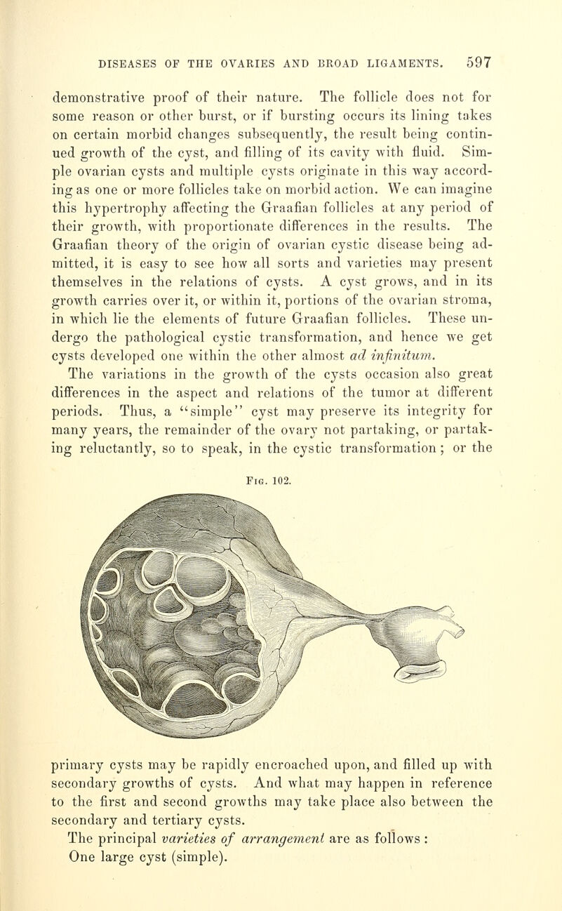 demonstrative proof of their nature. The follicle does not for some reason or other burst, or if bursting occurs its lining takes on certain morbid changes subsequently, the result being contin- ued growth of the cyst, and filling of its cavity with fluid. Sim- ple ovarian cysts and multiple cysts originate in this way accord- ing as one or more follicles take on morbid action. We can imagine this hypertrophy affecting the Graafian follicles at any period of their growth, with proportionate differences in the results. The Graafian theory of the origin of ovarian cystic disease being ad- mitted, it is easy to see how all sorts and varieties may present themselves in the relations of cysts. A cyst grows, and in its growth carries over it, or within it, portions of the ovarian stroma, in which lie the elements of future Graafian follicles. These un- dergo the pathological cystic transformation, and hence we get cysts developed one within the other almost ad infinitum. The variations in the growth of the cysts occasion also great differences in the aspect and relations of the tumor at different periods. Thus, a simple cyst may preserve its integrity for many years, the remainder of the ovary not partaking, or partak- ing reluctantly, so to speak, in the cystic transformation ; or the Fig. 102. -^ primary cysts may be rapidly encroached upon, and filled up with secondary growths of cysts. And what may happen in reference to the first and second growths may take place also between the secondary and tertiary cysts. The principal varieties of arrangement are as follows : One large cyst (simple).