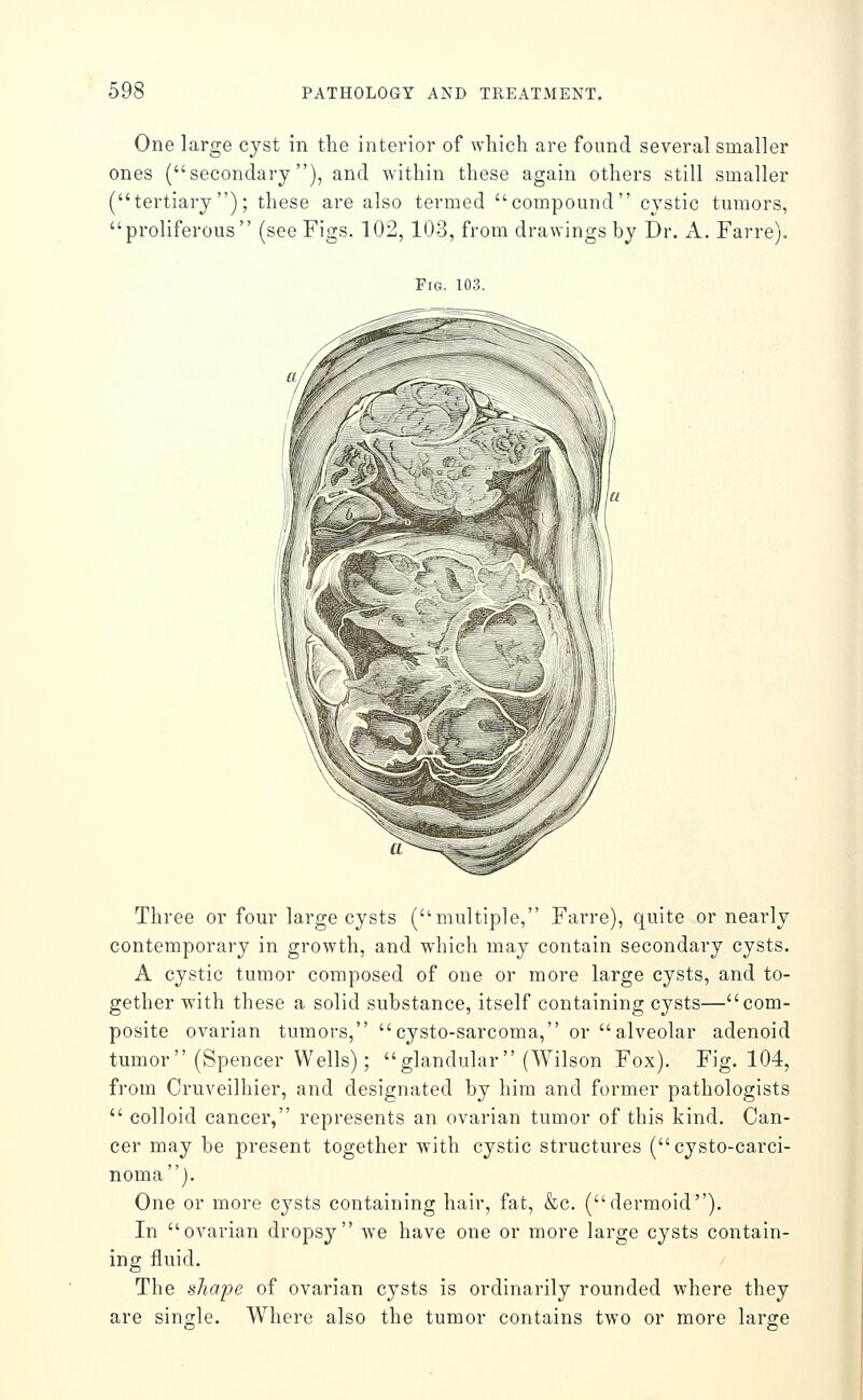 One large cyst in the interior of which are found several smaller ones (secondary), and within these again others still smaller (tertiary); these are also termed compound cystic tumors, proliferous (see Figs. 102, 103, from drawings by Dr. A. Farre). Fig. 103. Three or four large cysts (multiple, Farre), quite or nearly contemporary in growth, and which may contain secondary cysts. A cystic tumor composed of one or more large cysts, and to- gether with these a solid substance, itself containing cysts—com- posite ovarian tumors, cysto-sarcoma, or alveolar adenoid tumor (Spencer Wells); glandular (Wilson Fox), Fig. 104, from Cruveilhier, and designated by him and former pathologists  colloid cancer, represents an ovarian tumor of this kind. Can- cer may be present together with cystic structures (cysto-carci- nomaj. One or more cysts containing hair, fat, &c. (dermoid). In ovarian dropsy we have one or more large cysts contain- ing fluid. The shape of ovarian cysts is ordinarily rounded where they are single. Where also the tumor contains two or more large