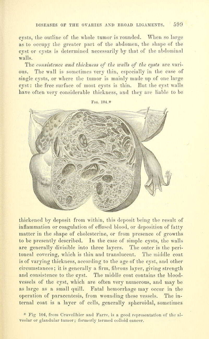 cysts, the outline of the whole tumor is rounded. When so large as to occupy the greater part of the abdomen, the shape of the cyst or cj'sts is determined necessarily by that of the abdominal walls. The consistence and thickness of the tvalls of the cysts are vari- ous. The wall is sometimes very thin, especially in the case of single cysts, or where the tumor is mainly made up of one large cyst: the free surface of most cysts is thin. But the cyst walls have often very considerable thickness, and they are liable to be Fig. 104.* thickened by deposit from within, this deposit being the result of inflammation or coagulation of eifused blood, or deposition of fatty matter in the shape of cholesterine, or from presence of growths to be presently described. In the case of simple cysts, the walls are generally divisible into three layers. The outer is the peri- toneal covering, which is thin and translucent. The middle coat is of varying thickness, according to the age of the cyst, and other circumstances; it is generally a firm, fibrous layer, giving strength and consistence to the cyst. The middle coat contains the blood- vessels of the cyst, which are often very numerous, and may be as large as a small quill. Fatal hemorrhage may occur in the operation of paracentesis, fi-om wounding these vessels. The in- ternal coat is a layer of cells, generally spheroidal, sometimes * Pig 104, from Cruveilhier and Farre, is a good representation of the al- veolar or glandular tumor; formerly termed colloid cancer.