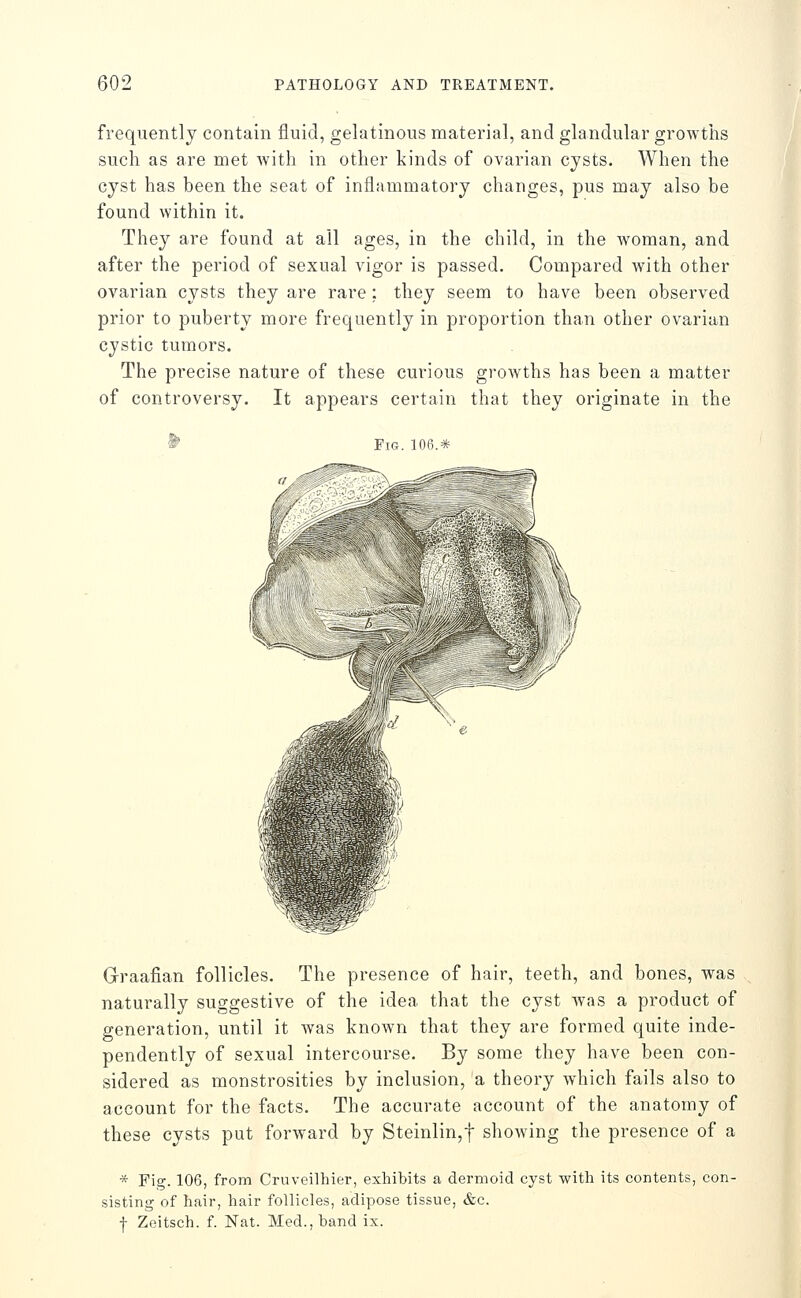 frequently contain fluid, gelatinous material, and glandular growths such as are met with in other kinds of ovarian cysts. When the cyst has been the seat of inflammatory changes, pus may also be found within it. They are found at all ages, in the child, in the woman, and after the period of sexual vigor is passed. Compared Avith other ovarian cysts they are rare; they seem to have been observed prior to puberty more frequently in proportion than other ovarian cystic tumors. The precise nature of these curious growths has been a matter of controversy. It appears certain that they originate in the ^ Fig. 106.* Graafian follicles. The presence of hair, teeth, and bones, was naturally suggestive of the idea that the cyst was a product of generation, until it w^as known that they are formed quite inde- pendently of sexual intercourse. By some they have been con- sidered as monstrosities by inclusion, a theory which fails also to account for the facts. The accurate account of the anatomy of these cysts put forward by Steinlin,t showing the presence of a * Fig. 106, from Cruveilhier, exhibits a dermoid cyst with its contents, con- sisting of hair, hair follicles, adipose tissue, &c. f Zeitsch. f. Nat. Med., band ix.