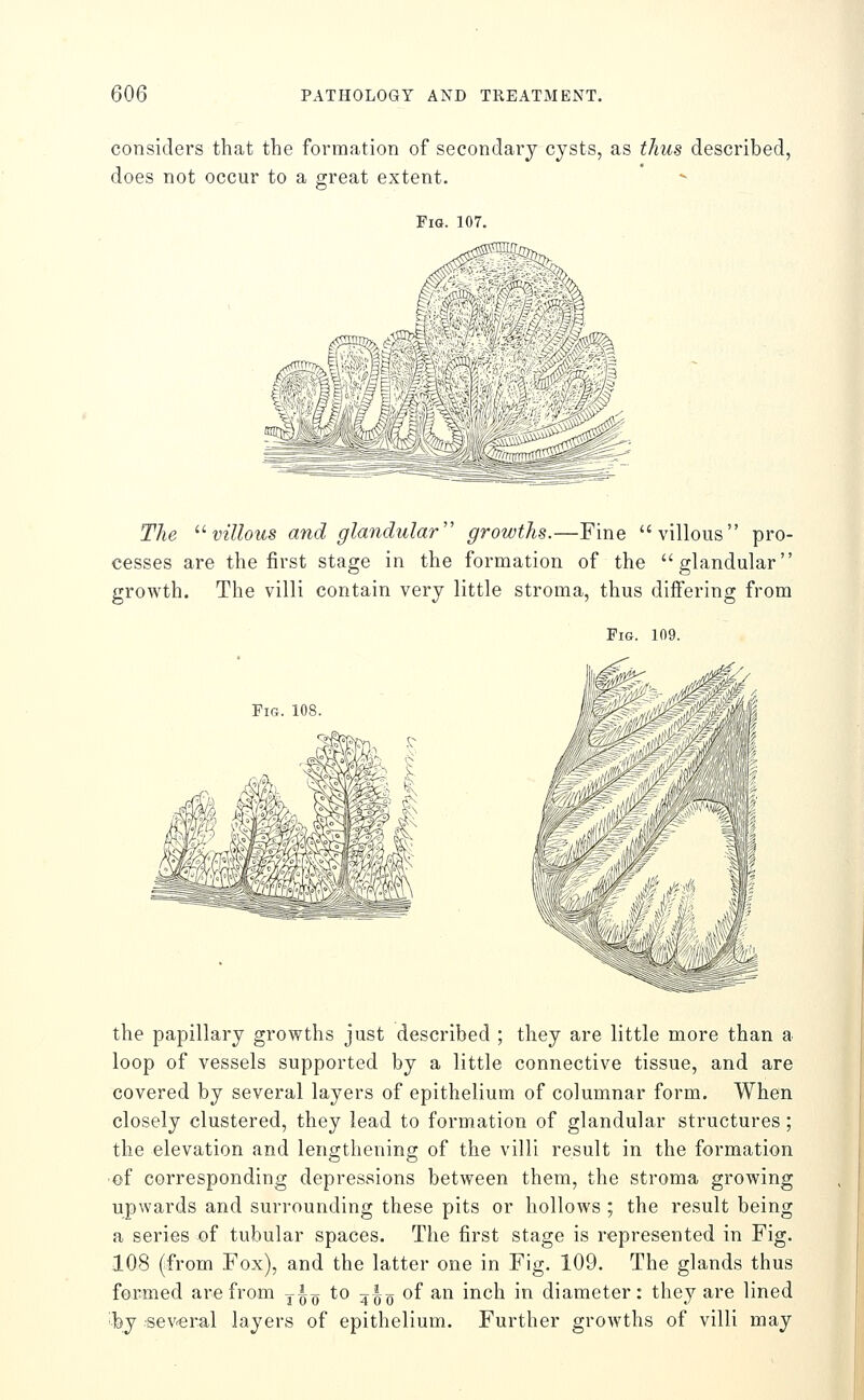 considers that the formation of secondary cysts, as thus described, does not occur to a great extent. Fig. 107. a^ \ 'w. The ^^ villous and glandular growths.—Fine villous pro- cesses are the first stage in the formation of the glandular growth. The villi contain very little stroma, thus differing from Fig. 109. Fig. 108. the papillary growths just described ; they are little more than a loop of vessels supported by a little connective tissue, and are covered by several layers of epithelium of columnar form. When closely clustered, they lead to formation of glandular structures; the elevation and lengthening of the villi result in the formation • of corresponding depressions between them, the stroma growing upwards and surrounding these pits or hollows; the result being a series of tubular spaces. The first stage is represented in Fig. 108 (from Fox), and the latter one in Fig. 109. The glands thus formed are from yi^ to ^i^ of an inch in diameter: they are lined 'by several layers of epithelium. Further growths of villi may