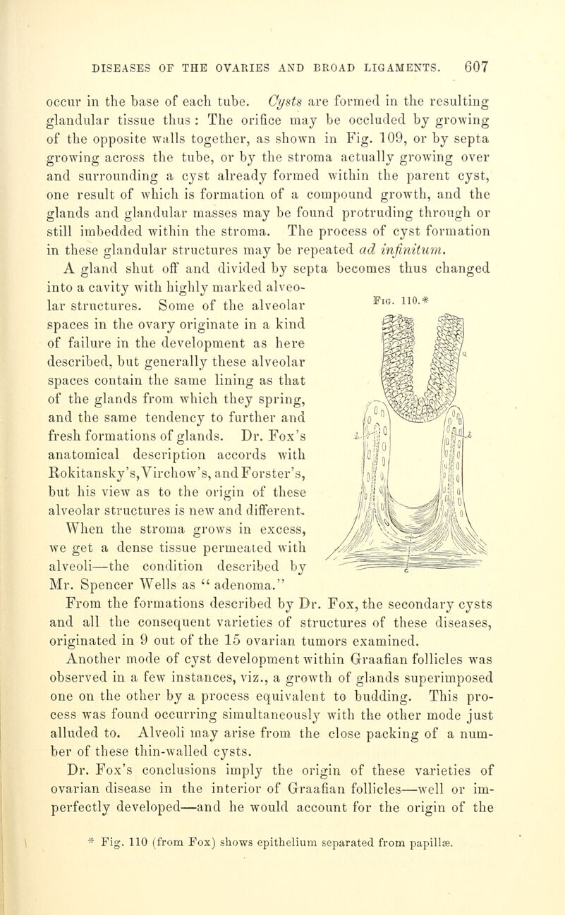 Fig. 110.* occur in the base of each tube. Cysts are formed in the resulting glandular tissue thus : The orifice may be occluded by growing of the opposite walls together, as shown in Fig. 109, or by septa growing across the tube, or by the stroma actually growing over and surrounding a cyst already formed within the parent cyst, one result of which is formation of a compound growth, and the glands and glandular masses may be found protruding through or still imbedded within the stroma. The process of cyst formation in these glandular structures may be repeated ad, infinitum. A gland shut off and divided by septa becomes thus changed into a cavity with highly marked alveo- lar structures. Some of the alveolar spaces in the ovary originate in a kind of failure in the development as here described, but generally these alveolar spaces contain the same lining as that of the glands from which they spring, and the same tendency to further and fresh formations of glands. Dr. Fox's anatomical description accords with Rokitansky's,Virchow's, and Forster's, but his view as to the origin of these alveolar structures is neAV and different. When the stroma grows in excess, we get a dense tissue permeated with alveoli—the condition described by Mr. Spencer Wells as  adenoma. From the formations described by Br. Fox, the secondary cysts and all the consequent varieties of structures of these diseases, originated in 9 out of the 15 ovarian tumors examined. Another mode of cyst development within Graafian follicles was observed in a few instances, viz., a growth of glands superimposed one on the other by a process equivalent to budding. This pro- cess was found occurring simultaneously with the other mode just alluded to. Alveoli may arise from the close packing of a num- ber of these thin-Avalled cysts. Dr. Fox's conclusions imply the origin of these varieties of ovarian disease in the interior of Graafian follicles—well or im- perfectly developed—and he would account for the origin of the Fig, 110 (from Fox) shows epithelium separated from papillas.
