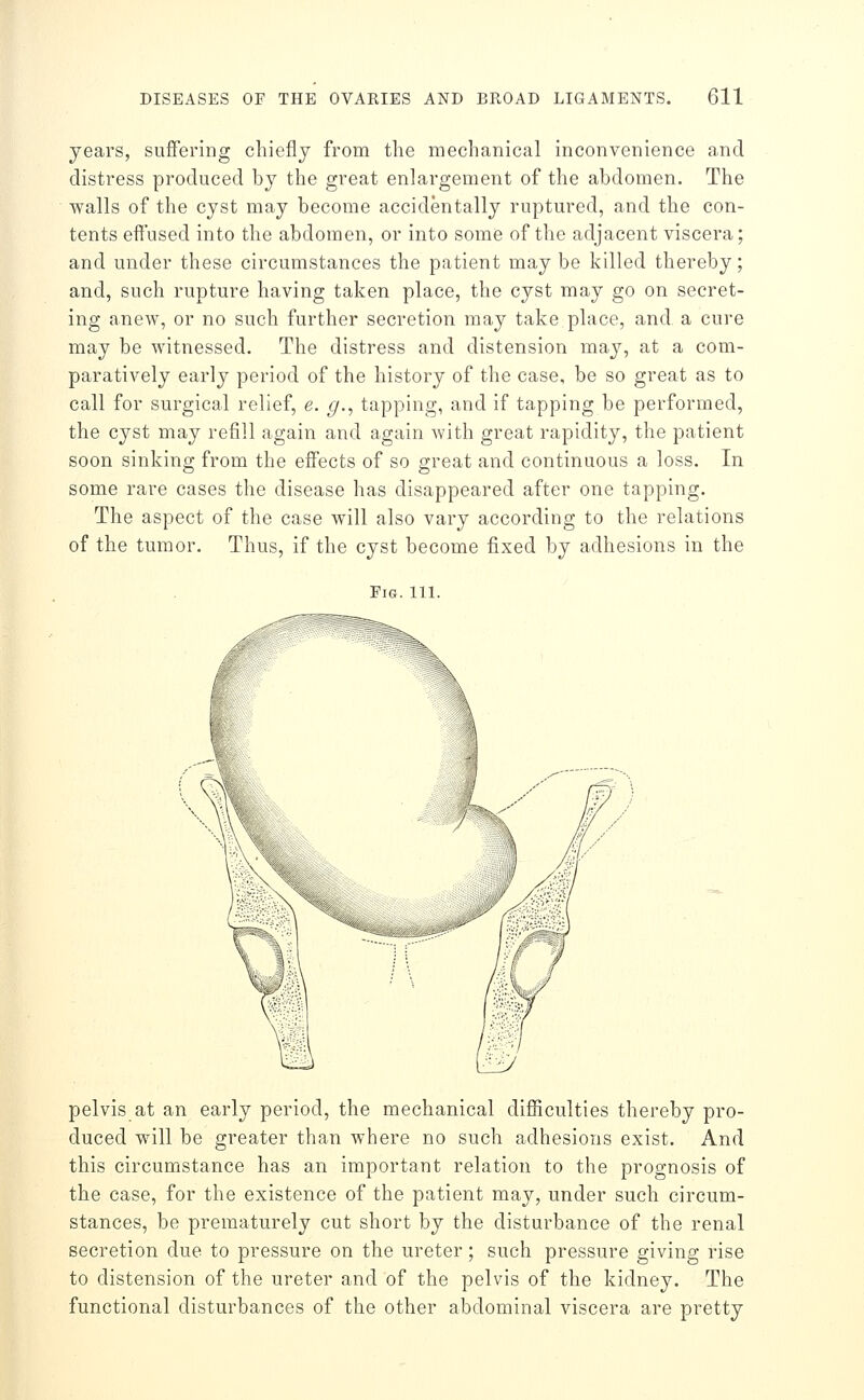years, suffering chiefly from the mechanical inconvenience and distress produced by the great enlargement of the abdomen. The walls of the cyst may become accidentally ruptured, and the con- tents effused into the abdomen, or into some of the adjacent viscera; and under these circumstances the patient may be killed thereby; and, such rupture having taken place, the cyst may go on secret- ing anew, or no such further secretion may take place, and a cure may be witnessed. The distress and distension may, at a com- paratively early period of the history of the case, be so great as to call for surgical relief, e. g., tapping, and if tapping be performed, the cyst may refill again and again with great rapidity, the patient soon sinking from the effects of so great and continuous a loss. In some rare cases the disease has disappeared after one tapping. The aspect of the case will also vary according to the relations of the tumor. Thus, if the cyst become fixed by adhesions in the Fig. 111. pelvis at an early period, the mechanical difficulties thereby pro- duced will be greater than where no such adhesions exist. And this circumstance has an important relation to the prognosis of the case, for the existence of the patient may, under such circum- stances, be prematurely cut short by the disturbance of the renal secretion due to pressure on the ureter; such pressure giving rise to distension of the ureter and of the pelvis of the kidney. The functional disturbances of the other abdominal viscera are pretty
