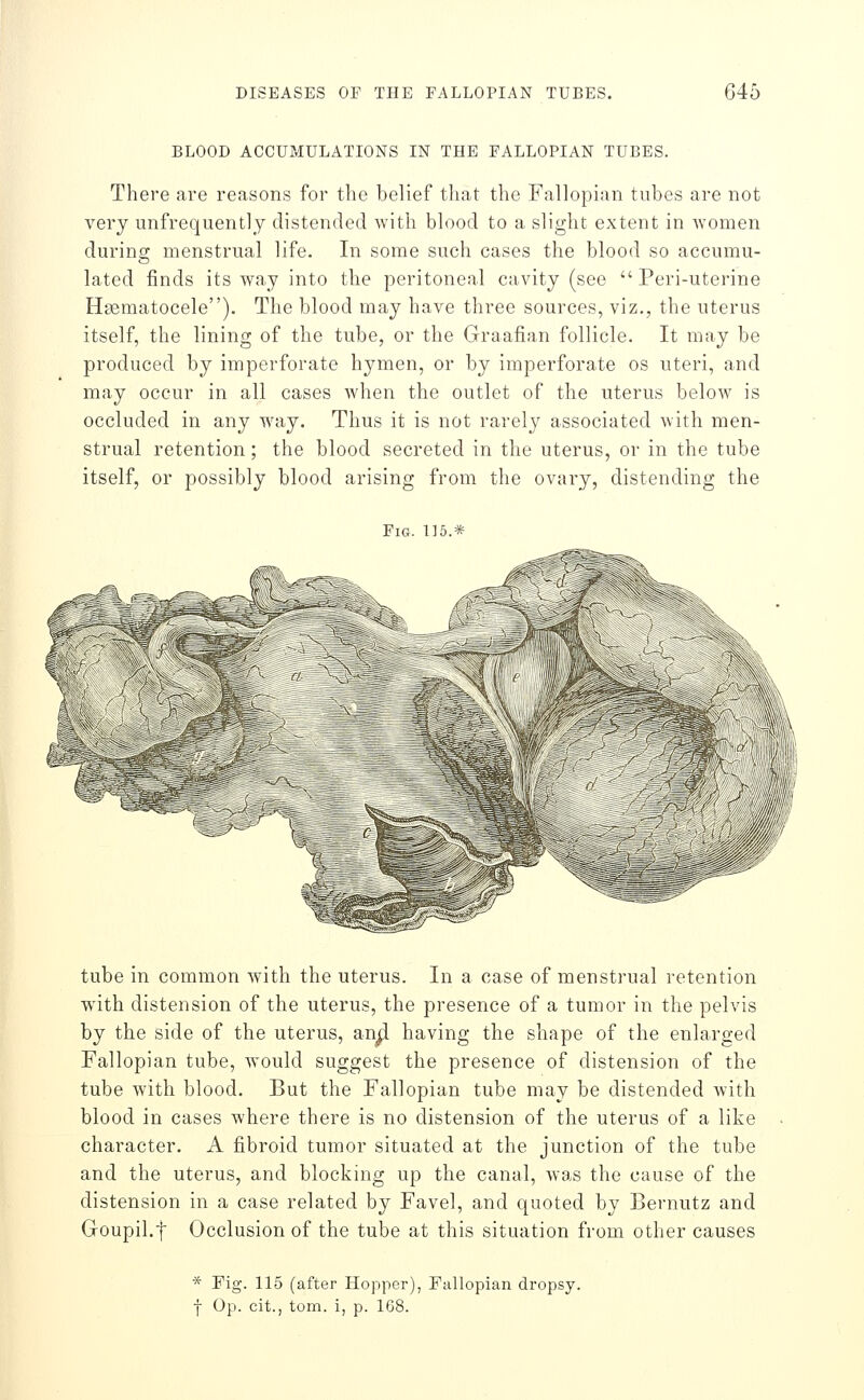 BLOOD ACCUMULATIONS IN THE FALLOPIAN TUBES. There are reasons for the belief that the Fallopian tubes are not very unfrequently distended with blood to a slight extent in women during menstrual life. In some such cases the blood so accumu- lated finds its way into the peritoneal cavity (see Peri-uterine H83matocele). The blood may have three sources, viz., the uterus itself, the lining of the tube, or the Graafian follicle. It may be produced by imperforate hymen, or by imperforate os uteri, and may occur in all cases when the outlet of the uterus below is occluded in any way. Thus it is not rarely associated with men- strual retention; the blood secreted in the uterus, or in the tube itself, or possibly blood arising from the ovary, distending the Fig. 115.* ^-\ tube in common with the uterus. In a case of menstrual retention with distension of the uterus, the presence of a tumor in the pelvis by the side of the uterus, an^ having the shape of the enlarged Fallopian tube, would suggest the presence of distension of the tube with blood. But the Fallopian tube may be distended with blood in cases where there is no distension of the uterus of a like character. A fibroid tumor situated at the junction of the tube and the uterus, and blocking up the canal, was the cause of the distension in a case related by Favel, and quoted by Bernutz and Goupil.f Occlusion of the tube at this situation from other causes * Fig. 115 (after Hopper), Fallopian dropsy, f Op. cit., torn, i, p. 1G8.