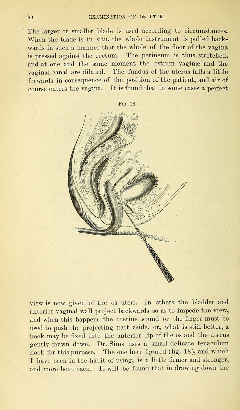 The larger or smaller blade is used according to circumstances. When the blade is in situ, the whole instrument is pulled back- wards in such a manner that the whole of the floor of the vagina is pressed against the rectum. The perineum is thus stretched, and at one and the same moment the ostium vaginae and the vaginal canal are dilated. The fundus of the uterus falls a little forwards in consequence of the position of the patient, and air of course enters the vagina. It is found that in some cases a perfect Fig. 18. view is now given of the os uteri. In others the bladder and anterior vaginal wall project backwards so as to impede the view, and when this happens the uterine sound or the finger must be used to push the projecting part aside, or, what is still better, a hook may be fixed into the anterior lip of the os and the uterus gently drawn down. Dr. Sims uses a small delicate tenaculum hook for this purpose. The one here figured (fig. 18), and which I have been in the habit of using, is a little firmer and stronger, and more bent back. It will be found that in drawing down the