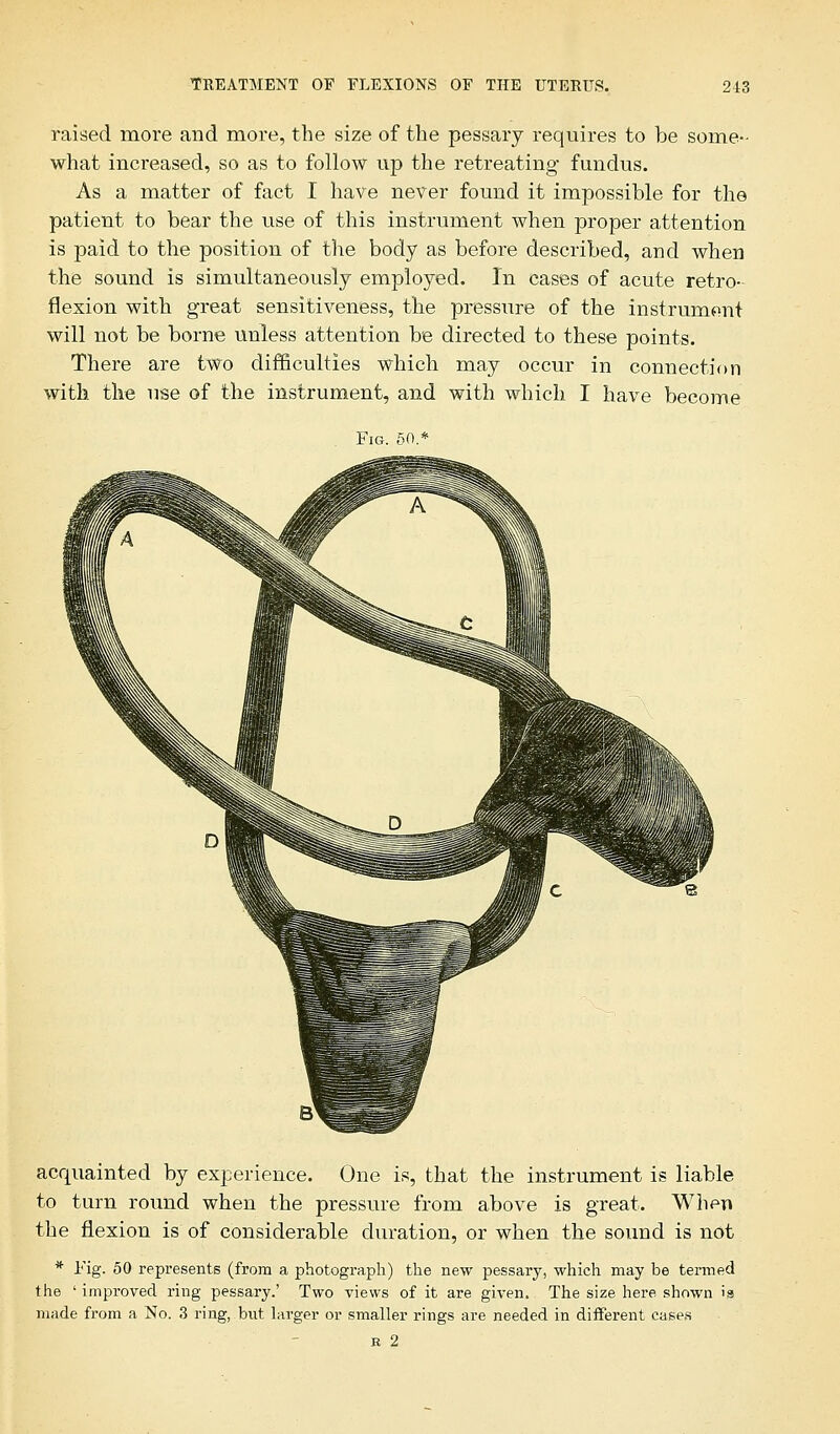 raised more and more, the size of the pessary requires to be some- what increased, so as to follow up the retreating fundus. As a matter of fact I have never found it impossible for the patient to bear the use of this instrument when proper attention is paid to the position of the body as before described, and when the sound is simultaneously employed. In cases of acute retro- flexion with great sensitiveness, the pressure of the instrument will not be borne unless attention be directed to these points. There are two difficulties which may occur in connection with the use of the instrument, and with which I have become acquainted by experience. One is, that the instrument is liable to turn round when the pressure from above is great. When the flexion is of considerable duration, or when the sound is not * Fig. 50 represents (from a photograph) the new pessary, which may be termed the ' improved ring pessary.' Two views of it are given. The size here shown is made from a No. 3 ring, but larger or smaller rings are needed in different cases b 2