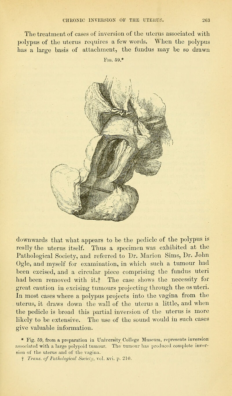 The treatment of cases of inversion of the uterus associated with polypus of the uterus requires a few words. When the polypus has a large basis of attachment, the fundus may be so drawn Fig. 59.* LJw downwards that what appears to be the pedicle of the polypus is really the uterus itself. Thus a specimen was exhibited at the Pathological Society, and referred to Dr. Marion Sims, Dr. John Ogle, and myself for examination, in which such a tumour had been excised, and a circular piece comprising the fundus Uteri had been removed with it.f The case shows the necessity for great caution in excising tumours projecting through the os uteri. In most cases where a polypus projects into the vagina from the uterus, it draws down the wall of the uterus a little, and when the pedicle is broad this partial inversion of the uterus is more likely to be extensive. The use of the sound would in such cases give valuable information. * Fig. 59, from a preparation in University College Museum, represents inversion associated with a large polypoid tumour. The tumour has produced complete inver- sion of the uterus and of the vagina. f Trans, of Pathological Society, vol. xvi. p. 210.