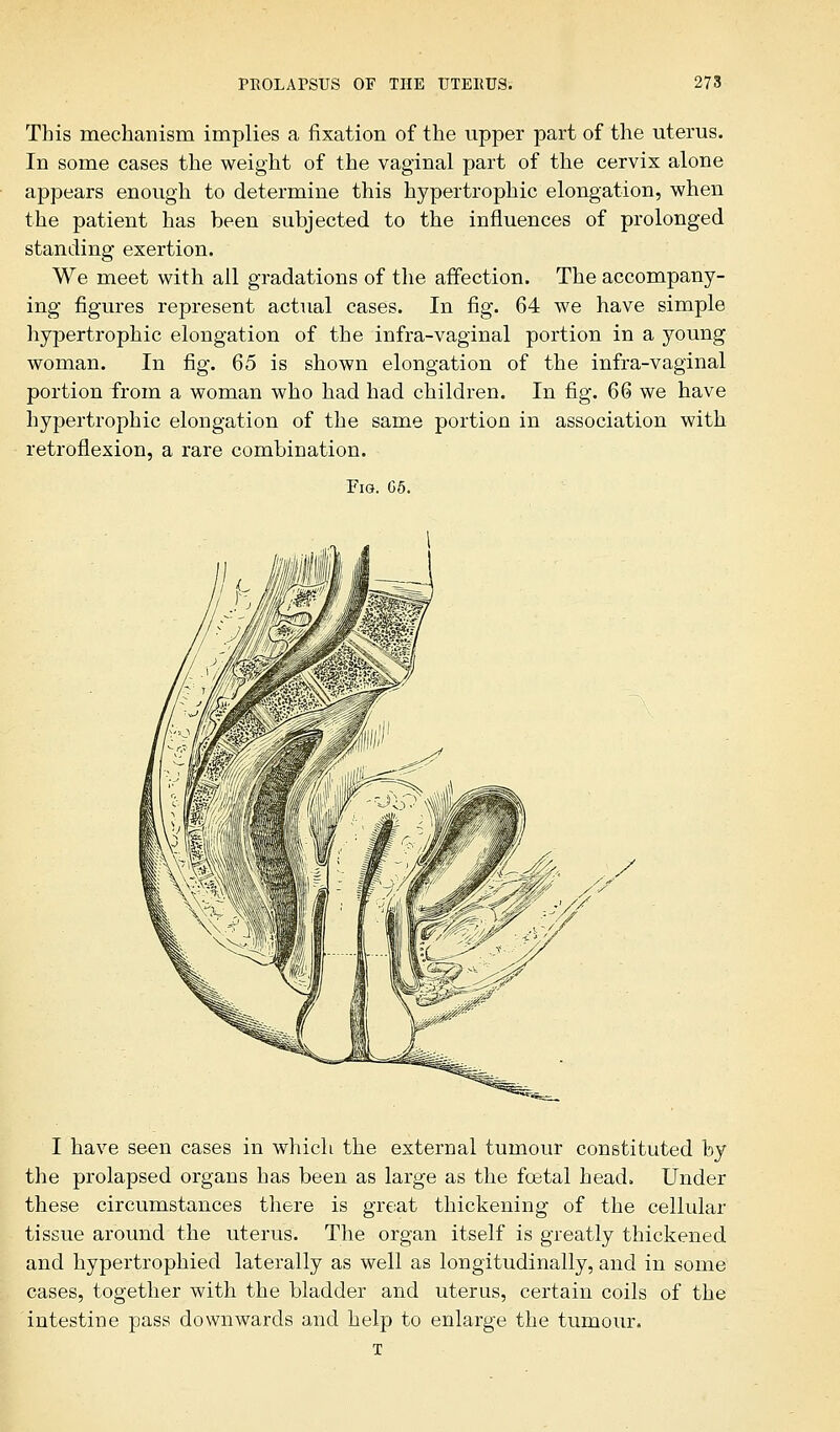 This mechanism implies a fixation of the upper part of the uterus. In some cases the weight of the vaginal part of the cervix alone appears enough to determine this hypertrophic elongation, when the patient has been subjected to the influences of prolonged standing exertion. We meet with all gradations of the affection. The accompany- ing figures represent actual cases. In fig. 64 we have simple hypertrophic elongation of the infra-vaginal portion in a young woman. In fig. 65 is shown elongation of the infra-vaginal portion from a woman who had had children. In fig. 66 we have hypertrophic elongation of the same portion in association with retroflexion, a rare combination. Fig. 05. I have seen cases in which the external tumour constituted by the prolapsed organs has been as large as the foetal head. Under these circumstances there is great thickening of the cellular tissue around the uterus. The organ itself is greatly thickened and hypertrophied laterally as well as longitudinally, and in some cases, together with the bladder and uterus, certain coils of the intestine pass downwards and help to enlarge the tumour. T