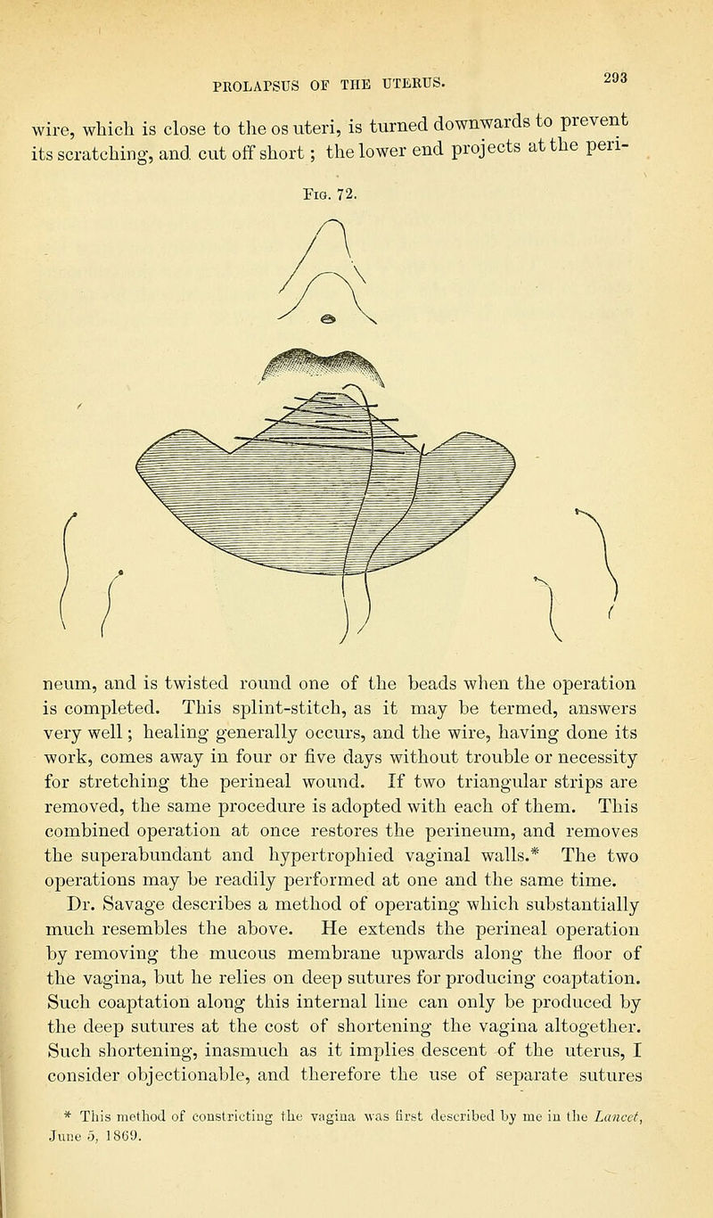 wire, which is close to the os uteri, is turned downwards to prevent its scratching, and cut off short; the lower end projects at the pen- Fig. 72. neum, and is twisted round one of the beads when the operation is completed. This splint-stitch, as it may be termed, answers very well; healing generally occurs, and the wire, having done its work, comes away in four or five days without trouble or necessity for stretching the perineal wound. If two triangular strips are removed, the same procedure is adopted with each of them. This combined operation at once restores the perineum, and removes the superabundant and hypertrophied vaginal walls.* The two operations may be readily performed at one and the same time. Dr. Savage describes a method of operating which substantially much resembles the above. He extends the perineal operation by removing the mucous membrane upwards along the floor of the vagina, but he relies on deep sutures for producing coaptation. Such coaptation along this internal line can only be produced by the deep sutures at the cost of shortening the vagina altogether. Such shortening, inasmuch as it implies descent of the uterus, I consider objectionable, and therefore the use of separate sutures * This method of constricting the vagina was first described by me in the Lancet, June .5, 1869.