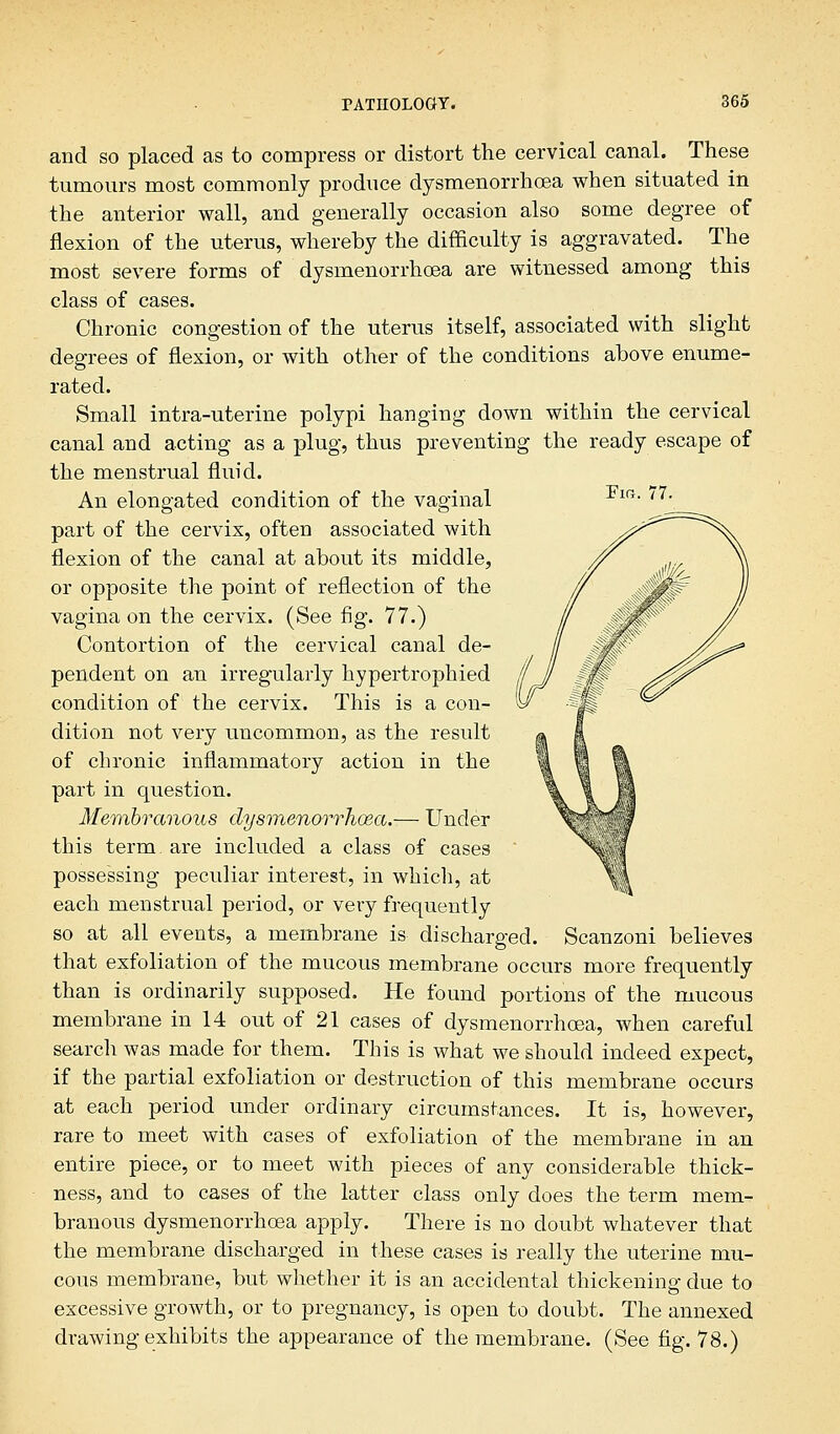 and so placed as to compress or distort the cervical canal. These tumours most commonly produce dysmenorrhoea when situated in the anterior wall, and generally occasion also some degree of flexion of the uterus, whereby the difficulty is aggravated. The most severe forms of dysmenorrhoea are witnessed among this class of cases. Chronic congestion of the uterus itself, associated with slight degrees of flexion, or with other of the conditions above enume- rated. Small intra-uterine polypi hanging down within the cervical canal and acting as a plug, thus preventing the ready escape of the menstrual fluid. An elongated condition of the vaginal part of the cervix, often associated with flexion of the canal at about its middle, or opposite the point of reflection of the vagina on the cervix. (See fig. 77.) Contortion of the cervical canal de- pendent on an irregularly hypertrophied condition of the cervix. This is a con- dition not very uncommon, as the result of chronic inflammatory action in the part in question. Membranous dysmenorrhoea.— Under this term, are included a class of cases possessing peculiar interest, in which, at each menstrual period, or very frequently so at all events, a membrane is discharged. Scanzoni believes that exfoliation of the mucous membrane occurs more frequently than is ordinarily supposed. He found portions of the mucous membrane in 14 out of 21 cases of dysmenorrhoea, when careful search was made for them. This is what we should indeed expect, if the partial exfoliation or destruction of this membrane occurs at each period under ordinary circumstances. It is, however, rare to meet with cases of exfoliation of the membrane in an entire piece, or to meet with pieces of any considerable thick- ness, and to cases of the latter class only does the term mem- branous dysmenorrhoea apply. There is no doubt whatever that the membrane discharged in these cases is really the uterine mu- cous membrane, but whether it is an accidental thickening due to excessive growth, or to pregnancy, is open to doubt. The annexed drawing exhibits the appearance of the membrane. (See fig. 78.)