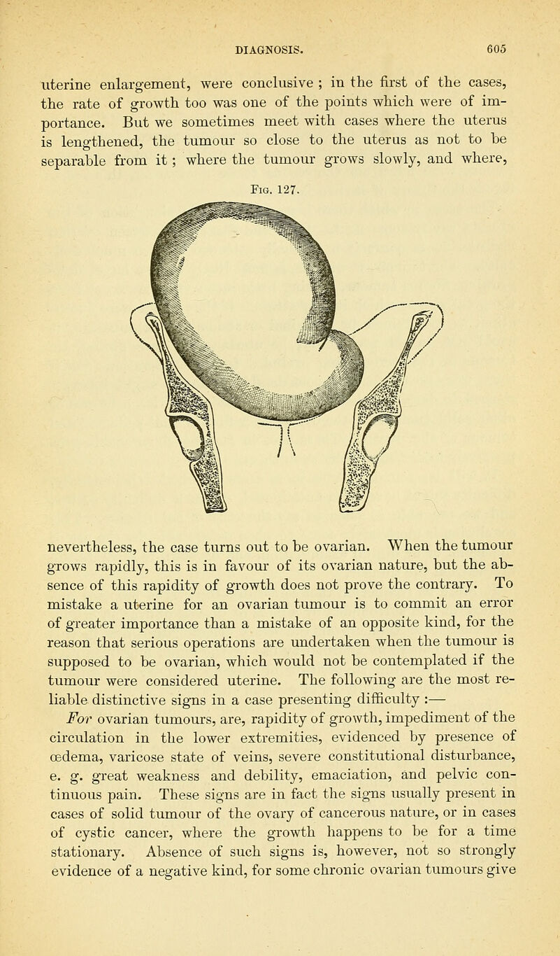 uterine enlargement, were conclusive ; in the first of the cases, the rate of growth too was one of the points which were of im- portance. But we sometimes meet with cases where the uterus is leno-thened, the tumour so close to the uterus as not to be separable from it; where the tumour grows slowly, and where, Fig. 127. nevertheless, the case turns out to be ovarian. When the tumour grows rapidly, this is in favour of its ovarian nature, but the ab- sence of this rapidity of growth does not prove the contrary. To mistake a uterine for an ovarian tumour is to commit an error of greater importance than a mistake of an opposite kind, for the reason that serious operations are undertaken when the tumour is supposed to be ovarian, which would not be contemplated if the tumour were considered uterine. The following are the most re- liable distinctive signs in a case presenting difficulty :— For ovarian tumours, are, rapidity of growth, impediment of the circulation in the lower extremities, evidenced by presence of oedema, varicose state of veins, severe constitutional disturbance, e. g. great weakness and debility, emaciation, and pelvic con- tinuous pain. These signs are in fact the signs usually present in cases of solid tumour of the ovary of cancerous nature, or in cases of cystic cancer, where the growth happens to be for a time stationary. Absence of such signs is, however, not so strongly evidence of a negative kind, for some chronic ovarian tumours give