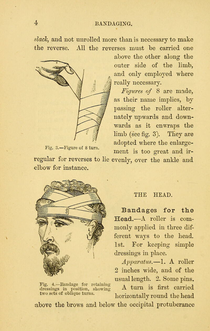 slacTc, and not unrolled more than is necessary to make the reverse. All the reverses must be carried one above the other along the outer side of the limb, and only employed where I really necessary. Figures of 8 are made, as their name implies, by passing the roller alter- nately upwards and down- wards as it enwraps the limb (see fig. 3). They are adopted where the enlarge- Fig. 3.—Figure of 8 turn. , • , . -i^- ment is too great and ir- regular for reverses to lie evenly, over the ankle and elbow for instance. Fig. 4.—Bandage for retaining dressings in position, showing tr\vo sets of oblique turns. THE HEAD. Bandages for the Head.—A roller is com- monly applied in three dif- ferent ways to the head. 1st. For keeping simple dressings in place. Apparatus.—1. A roller 2 inches wide, and of the usual lengtli. 2. Some pins. A turn is first carried horizontally round the head above the brows and below the occipital protuberance