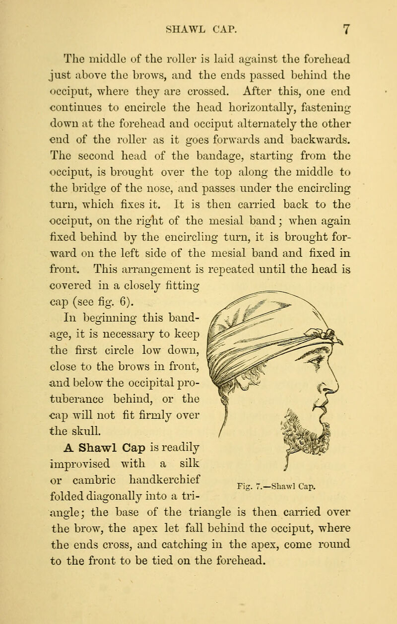 SHAWL CAP. The middle of the roller is laid against the forehead just above the brows, and the ends passed behind the occiput, where they are crossed. After this, one end continues to encircle the head horizontally, fastening down at the forehead and occiput alternately the other end of the roller as it goes forwards and backwards. The second head of the bandage, starting from the occiput, is brought over the top along the middle to the bridge of the nose, and passes under the encircling turn, which fixes it. It is then carried back to the occiput, on the right of the mesial band; when again fixed behind by the encircling turn, it is brought for- ward on the left side of the mesial band and fixed in front. This arrangement is repeated until the head is covered in a closely fitting cap (see fig. 6). In beginning this band- age, it is necessary to keep the first circle low down, close to the brows in front, and below the occipital pro- tuberance behind, or the cap will not fit firmly over the skull. A Shawl Cap is readily improvised with a silk or cambric handkerchief folded diagonally into a tri- angle; the base of the triangle is then carried over the brow, the apex let fall behind the occiput, where the ends cross, and catching in the apex, come round to the front to be tied on the forehead. Fig. 7.—Shawl Cap.