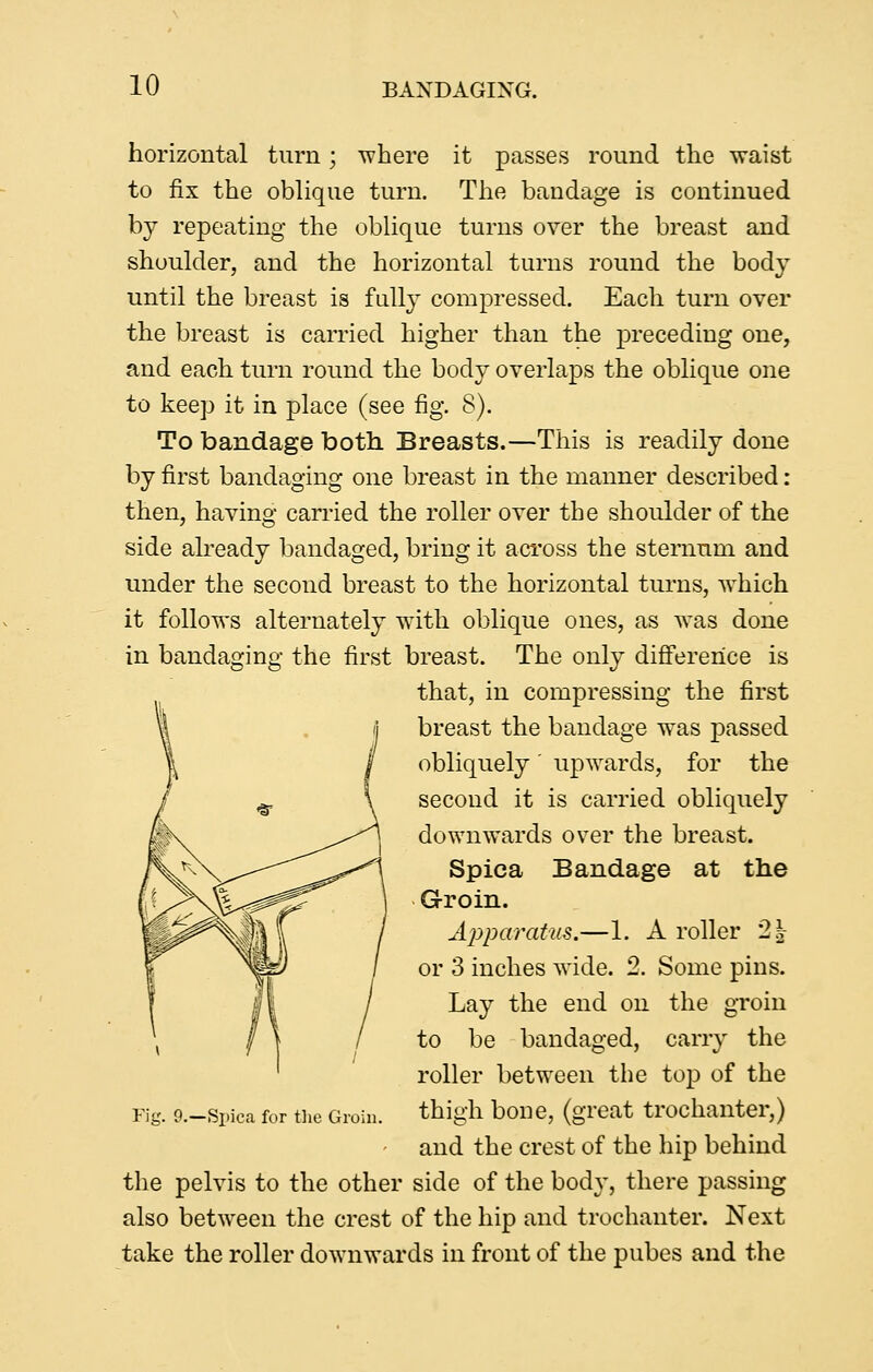 horizontal turn; where it passes round the waist to fix the oblique turn. The bandage is continued by repeating the oblique turns over the breast and shoulder, and the horizontal turns round the body until the breast is fully compressed. Each turn over the breast is carried higher than the preceding one, and each turn round the body overlaps the oblique one to keep it in place (see fig. 8). To bandage both Breasts.—This is readily done by first bandaging one breast in the manner described: then, having carried the roller over the shoulder of the side abeady bandaged, bring it aci'oss the sternum and under the second breast to the horizontal turns, which it follows alternately with oblique ones, as was done in bandaging the first breast. The only difi'ererice is that, in compressing the first breast the bandage was passed obliquely' upwards, for the second it is carried obliquely downwards over the breast. Spica Bandage at the Groin. Apparatus.—1. A roller 2| or 3 inches wide. 2. Some pins. Lay the end on the groin to be bandaged, carry the roller between the top of the thigh bone, (great trochanter,) and the crest of the hip behind the pelvis to the other side of the body, there passing also between the crest of the hip and trochanter. Next take the roller downwards in front of the pubes and the Fig. P.—Silica for tlie Groin.