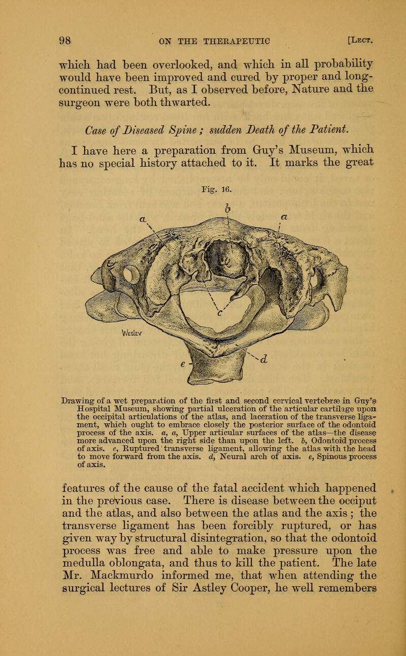 which, had been overlooked, and which in all probability would have been improved and cured by proper and long- continued rest. But, as I observed before, Nature and the surgeon were both thwarted. Case of Diseased Spine ; sudden Death of the Patient. I have here a preparation from Gruy's Museum, which has no special history attached to it. It marks the great Drawing of a wet preparation of the first and second cervical vertebrae in Guy's Hospital Museum, showing partial ulceration of the articulai- cartilage upon the occipital articulations of the atlas, and laceration of the transverse liga- ment, which ought to embrace closely the jKJsterior surface of the odontoid process of the axis, a, a, Upper articular surfaces of the atlas—the disease more advanced upon the right side than upon the left. &, Odontoid process of axis, c. Ruptured transverse ligament, allowing the atlas with the head to move forward from the axis, d, Neural arch of axis, e, Spinous process of axis. features of the cause of the fatal accident which happened in the previous case. There is disease between the occiput and the atlas, and also between the atlas and the axis ; the transverse ligament has been forcibly ruptured, or has given way by structural disintegration, so that the odontoid process was free and able to make pressure upon the medulla oblongata, and thus to kill the patient. The late Mr. Mackmurdo informed me, that when attending the surgical lectures of Sir Astley Cooper, he well remembers