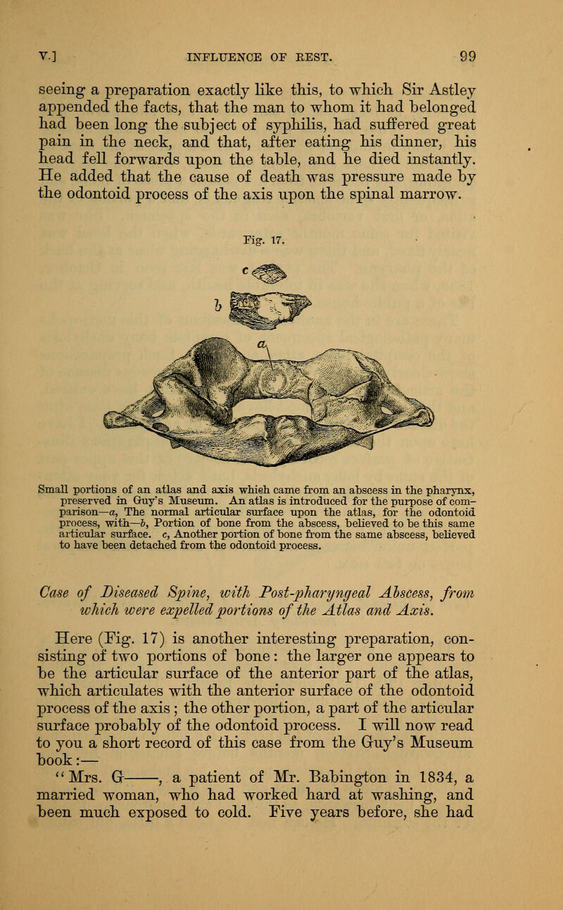 seeing a preparation exactly like tliis, to wMcli Sir Astley appended the facts, tliat the man to whom it had belonged had been long the subject of syphiKs, had suffered great pain in the neck, and that, after eating his dinner, his head fell forwards upon the table, and he died instantly. He added that the cause of death was pressure made by the odontoid process of the axis upon the spinal marrow. Small portions of an atlas and axis whieh came from an abscess in the pharynx, preserved in Guy's Museum. An atlas is introduced for the purpose of com- parison—a, The normal articular surface upon the atlas, for the odontoid process, with—b. Portion of bone from the abscess, believed to be this same articular surface, c. Another portion of bone fi'om the same abscess, believed to have been detached from the odontoid process. Case of Diseased Spine, with Fost-pharyngeal Abscess, from which were expelled portions of the Atlas and Axis. Here (Fig. 17) is another interesting preparation, con- sisting of two portions of bone : the larger one appears to be the articular surface of the anterior part of the atlas, which articulates with the anterior surface of the odontoid process of the axis ; the other portion, a part of the articular surface probably of the odontoid process. I will now read to you a short record of this case from the Gruy's Museum book:— ''Mrs. Gr , a patient of Mr. Babington in 1834, a married woman, who had worked hard at washing, and been much exposed to cold. Five years before, she had