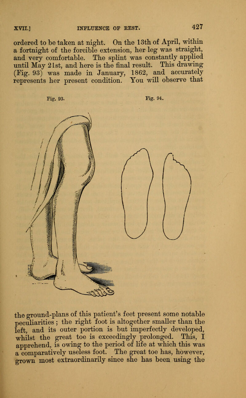 ordered to be taken at niglit. On the 13th of April, within a fortnight of the forcible extension, her leg was straight, and very comfortable. The splint was constantly applied until May 21st, and here is the final result. This drawing (Fig. 93) was made in January, 1862, and accurately represents her present condition. You will observe that Fig. 93. Fig. 94. the ground-plans of this patient's feet present some notable peculiarities ; the right foot is altogether smaller than the left, and its outer portion is but imperfectly developed, whilst the great toe is exceedingly prolonged. This, I apprehend, is owing to the period of life at which this was a comparatively useless foot. The great toe has, however, grown most extraordinarily since she has been using the