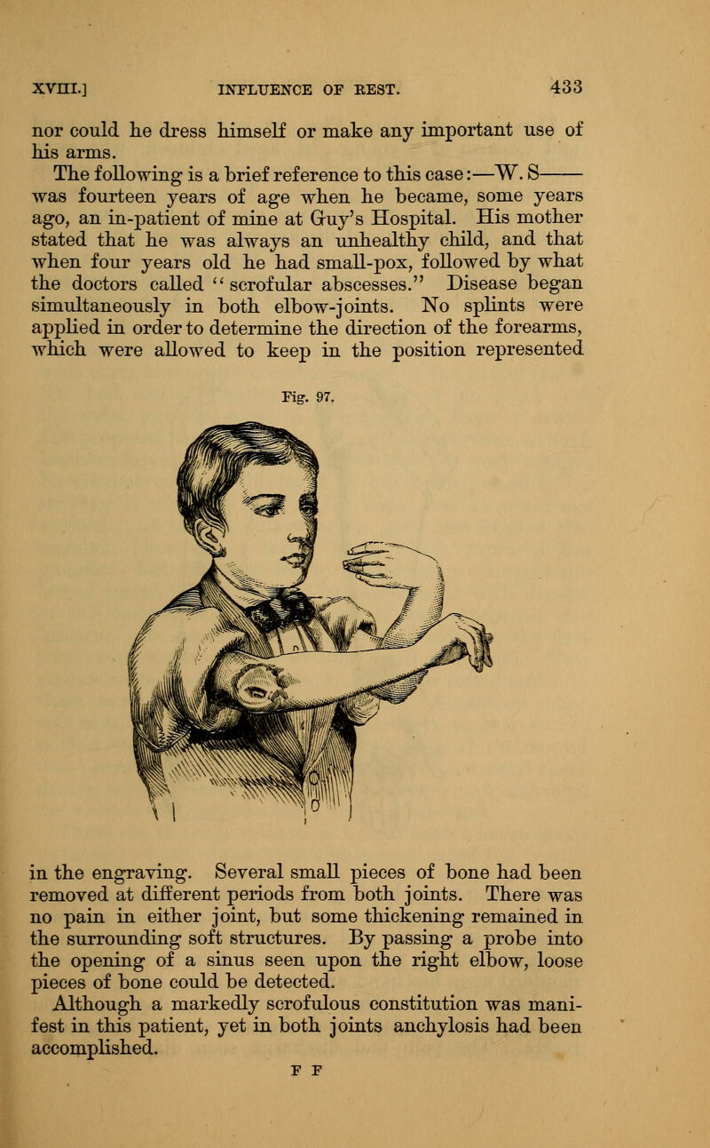 nor could lie dress himself or make any important use of his arms. The following is a brief reference to this case:—W. S was fourteen years of age when he became, some years ago, an in-patient of mine at Gruy's Hospital. His mother stated that he was always an unhealthy child, and that when four years old he had small-pox, followed by what the doctors called ''scrofular abscesses. Disease began simultaneously in both elbow-joints. No splints were applied in order to determine the direction of the forearms, which were allowed to keep in the position represented Fig. 97. in the engraving. Several small pieces of bone had been removed at different periods from both joints. There was no pain in either joint, but some thickening remained in the surrounding soft structures. By passing a probe into the opening of a sinus seen upon the right elbow, loose pieces of bone could be detected. Although a markedly scrofulous constitution was mani- fest in this patient, yet in both joints anchylosis had been accompKshed. F F