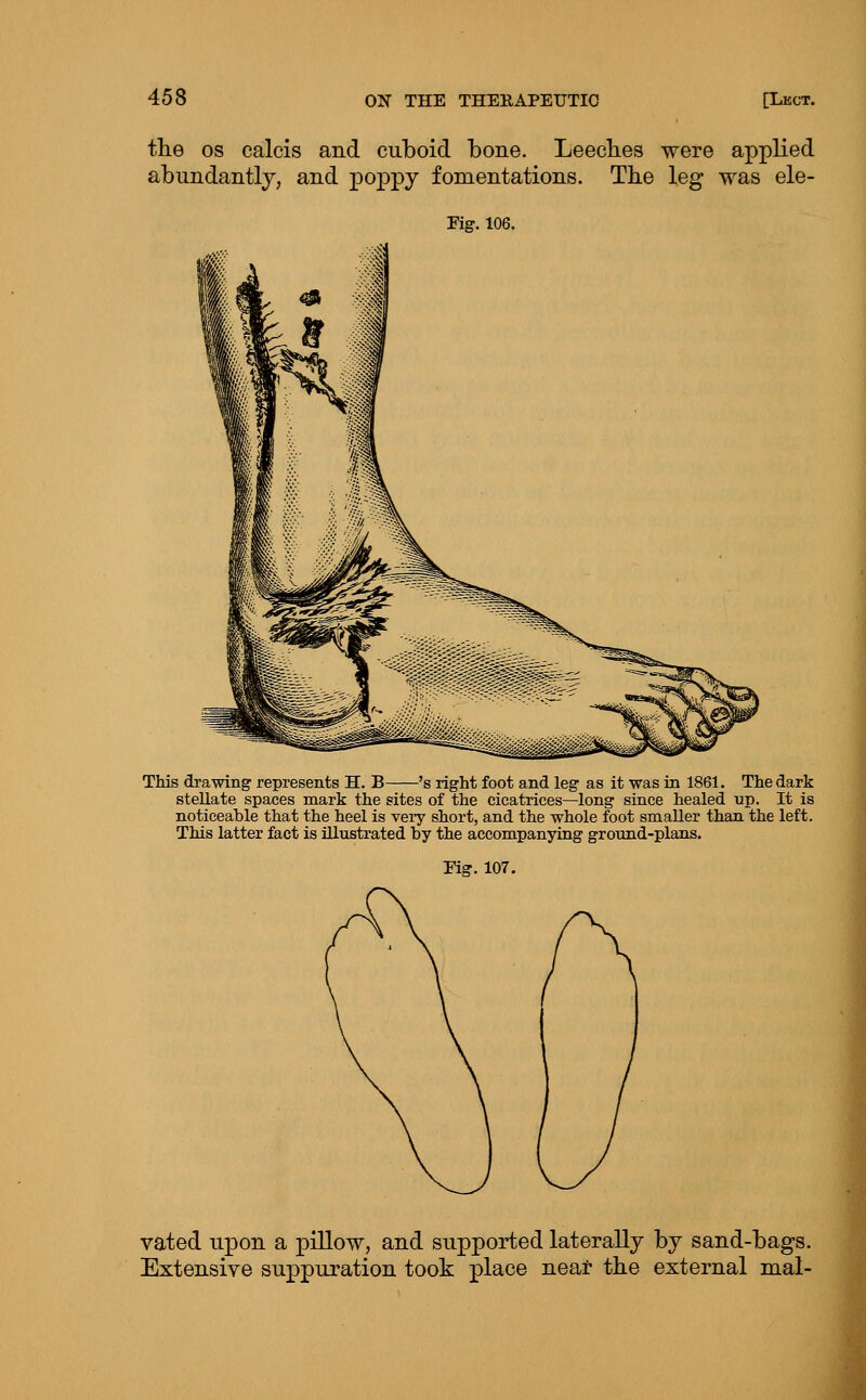 the OS calcis and cuboid bone. Leecbes were applied abundantly, and poppy fomentations. Tbe leg was ele- Fig. 106. This drawing represents H. B 's right foot and leg as it was in 1861. The dark stellate spaces mark the sites of the cicatrices—long since healed up. It is noticeable that the heel is very short, and the whole foot smaller than the left. This latter fact is illustrated by the accompanying ground-plans. Fig. 107. vated upon a piUow, and supported laterally by sand-bags. Extensive suppuration took place near tbe external mal-