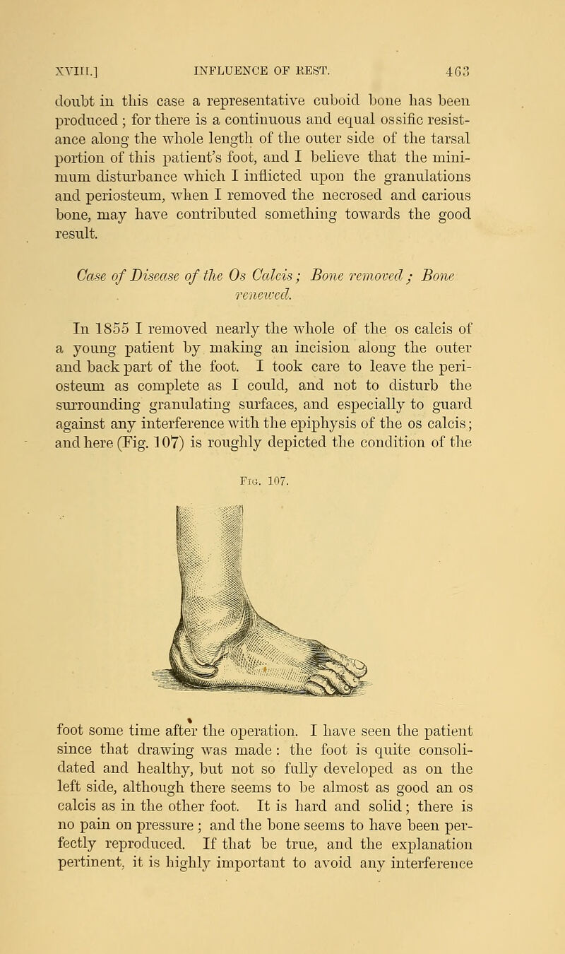 doubt in this case a representative cuboid bone has been produced ; for there is a continuous and equal ossific resist- ance along the whole length of the outer side of the tarsal portion of this patient's foot, and I believe that the mini- mum disturbance which I inflicted upon the granulations and periosteum, when I removed the necrosed and carious bone, may have contributed something towards the good result. Case of Disease of the Os Calcis; Bone removed ; Bone renewed. In 1855 I removed nearly the whole of the os calcis of a young patient by making an incision along the outer and back part of the foot. I took care to leave the peri- osteum as complete as I could, and not to disturb the surrounding granulating surfaces, and especially to guard against any interference with the epiphysis of the os calcis; and here (Fig. 107) is roughly depicted the condition of the Fra. 107. foot some time after the operation. I have seen the patient since that drawing was made: the foot is quite consoli- dated and healthy, but not so fully developed as on the left side, although there seems to be almost as good an os calcis as in the other foot. It is hard and solid; there is no pain on pressure ; and the bone seems to have been per- fectly reproduced. If that be true, and the explanation pertinent, it is highly important to avoid any interference