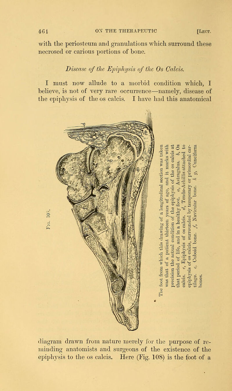 [Lect. with the periosteum and granulations which surround these necrosed or carious portions of bone. Disease of the Epiphysis of the Os Calcis. I must now allude to a morbid condition which, I believe, is not of very rare occurrence—namely, disease of the epiphysis of the os calcis. I have had this anatomical diagram drawn from nature merely for the purpose of re- minding anatomists and surgeons of the existence of the epiphysis to the os calcis. Here (Fig. 108) is the foot of a