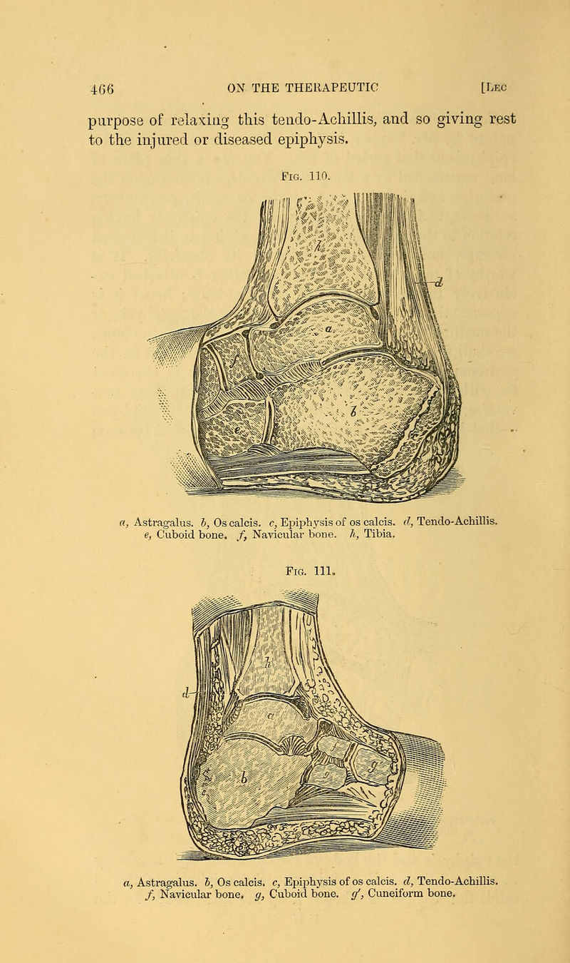 purpose of relaxing this tendo-Achillis, and so giving rest to the injured or diseased epiphysis. Fig. 110. a, Astragalus, b, Os calcis. c, Epiphysis of os calcis. d, Tendo-Achillis. e, Cuboid bone, f, Navicular bone, h, Tibia. Pig. 111. a, Astragalus, b, Os calcis. c, Epiphysis of os calcis. d, Tendo-Achillis. /, Navicular bone, g, Cuboid bone, g', Cuneiform bone.