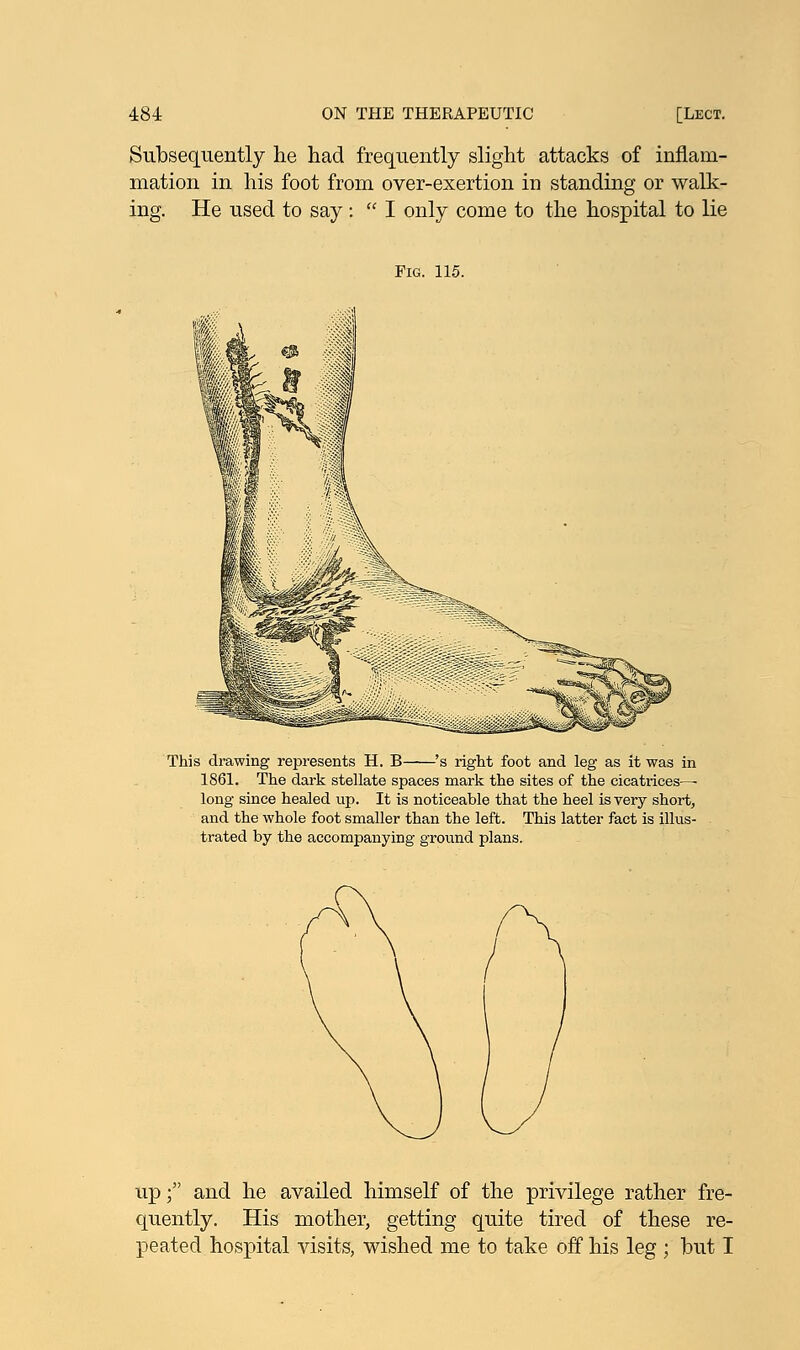 Subsequently he had frequently slight attacks of inflam- mation in his foot from over-exertion in standing or walk- ing. He used to say:  I only come to the hospital to lie Fig. 115. This drawing represents H. B 's right foot and leg as it was in 1861. The dark stellate spaces mark the sites of the cicatrices— long since healed up. It is noticeable that the heel is very short, and the whole foot smaller than the left. This latter fact is illus- trated by the accompanying ground plans. up; and he availed himself of the privilege rather fre- quently. His mother, getting quite tired of these re- peated hospital visits, wished me to take off his leg ; but I