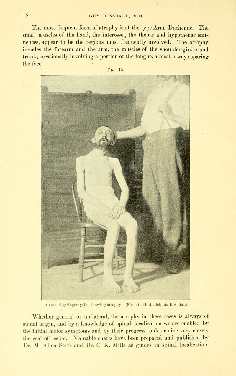 The most frequent form of atrophy is of the type Aran-Duchenne. The small muscles of the hand, the interossei, the thenar and hypothenar emi- nences, appear to be the regions most frequently involved. The atrophy invades the forearm and the arm, the muscles of the shoulder-girdle and trunk, occasionally involving a portion of the tongue, almost always sparing the face. Fig. 13. A case of syringomyelia, showing atrophy. (From tlic Phihvdelphia Hospital.) Whether general or unilateral, the atrophy in these cases is always of spinal origin, and by a knowledge of spinal localization we are enabled by the initial motor symptoms and by their progress to determine very closely the seat of lesion. Valuable charts have been prepared and published by Dr. M. Allen Starr and Dr. C. K. Mills as guides in spinal localization.