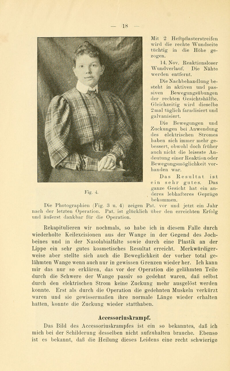 Mit 2 Heftpflasterstreifen wird die rechte Wundseite tüchtig in die Höhe ge- zogen. 14. Nov. Heaktionsloser Wundverlauf. Die Nähte werden entfernt. Die Nachbehandlung be- steht in aktiven und pas- siven Bewegungsübungen der rechten Gesichtshälfte. Gleichzeitig wird dieselbe 2 mal täglich faradisiert und galvanisiert. Die Bewegungen und Zuckungen bei Anwendung des elektrischen Stromes haben sich immer mehr ge- bessert, obwohl doch früher auch nicht die leiseste An- deutung einer Beaktion oder Bewegungsmöglichkeit vor- handen war. Das Resultat ist ein sehr gutes. Das ganze Gesicht hat ein an- deres lebhafteres Gepräge bekommen. Die Photographien (Fig. 3 u. 4) zeigen Bat. vor und jetzt ein Jahr nach der letzten Operation. Bat. ist glücklich über den erreichten Erfolg und äußerst dankbar für die Operation. Rekapitulieren wir nochmals, so habe ich in diesem Falle durch wiederholte Keilexcisionen aus der Wange in der Gegend des Joch- beines und in der Nasolabialfalte sowie durch eine Plastik an der Lippe ein sehr gutes kosmetisches Resultat erreicht. Merkwürdiger- weise aber stellte sich auch die Beweglichkeit der vorher total ge- lähmten Wange wenn auch nur in gewissen Grenzen wieder her. Ich kann mir das nur so erklären, das vor der Operation die gelähmten Teile durch die Schwere der Wange passiv so gedehnt waren, daß selbst durch den elektrischen Strom keine Zuckung mehr ausgelöst werden konnte. Erst als durch die Operation die gedehnten Muskeln verkürzt waren und sie gewissermaßen ihre normale Länge wieder erhalten hatten, konnte die Zuckung wieder statthaben. Accessoriiiskrampf. Das Bild des Accessoriuskrampfes ist ein so bekanntes, daß ich mich bei der Schilderung desselben nicht aufzuhalten brauche. Ebenso ist es bekannt, daß die Heilung dieses Leidens eine recht schwierige Fig. 4.