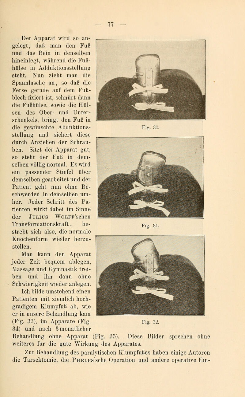 V. ^'^ —*^ Fig. 30. Der Apparat wird so an- gelegt, daß man den Fuß und das Bein in denselben hineinlegt, während die Fuß- hülse in Adduktionsstellung steht. Nun zieht man die Spannlasche an, so daß die Ferse gerade auf dem Fuß- blech fixiert ist, schnürt dann die Fußhülse, sowie die Hül- sen des Ober- und Unter- schenkels, bringt den Fuß in die gewünschte Abduktions- stellung und sichert diese durch Anziehen der Schrau- ben. Sitzt der Apparat gut, so steht der Fuß in dem- selben völlig normal. Es wird ein passender Stiefel über demselben gearbeitet und der Patient geht nun ohne Be- schwerden in demselben um- her. Jeder Schritt des Pa- tienten wirkt dabei im Sinne der Julius WoLFF'schen Transformationskraft, be- strebt sich also, die normale Knochenform wieder herzu- stellen. Man kann den Apparat jeder Zeit bequem ablegen, Massage und Gymnastik trei- ben und ihn dann ohne Schwierigkeit wieder anlegen. Ich bilde umstehend einen Patienten mit ziemlich hoch- gradigem Klumpfuß ab, wie er in unsere Behandlung kam 34) und nach 3 monatlicher Behandlung ohne Apparat (Fig. 35). Diese Bilder sprechen ohne weiteres für die gute Wirkung des Apparates. Zur Behandlung des paralytischen Klumpfußes haben einige Autoren die Tarsektomie, die PHELPs'sche Operation und andere operative Ein- Fis. 31.