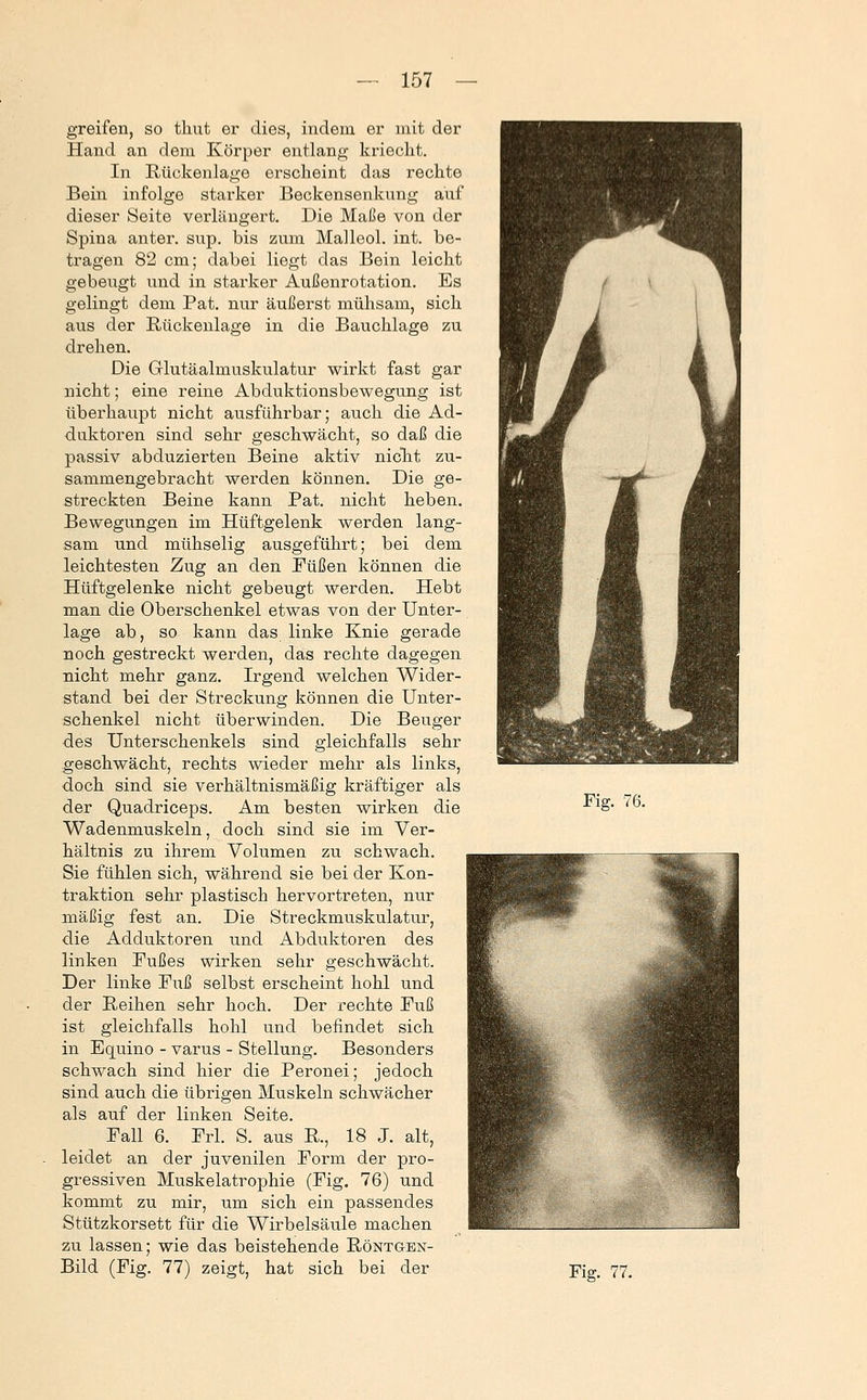 greifen, so tlmt er dies, indem er mit der Hand an dem Ivörper entlang kriecht. In Rückenlage erscheint das rechte Bein infolge starker Beckensenkung auf dieser Seite verlängert. Die Maße von der Spina anter. sup. bis zum Malleol. int. be- tragen 82 cm; dabei liegt das Bein leicht gebeugt und in starker Außenrotation. Es gelingt dem Pat. nur äußerst mühsam, sich aus der Rückenlage in die Bauchlage zu drehen. Die Glutäalmuskulatur wirkt fast gar nicht; eine reine Abduktionsbewegung ist überhaupt nicht ausführbar; auch die Ad- duktoren sind sehr geschwächt, so daß die passiv abduzierten Beine aktiv nicht zu- sammengebracht werden können. Die ge- streckten Beine kann Pat. nicht heben. Bewegungen im Hüftgelenk werden lang- sam und mühselig ausgeführt; bei dem leichtesten Zug an den Füßen können die Hüftgelenke nicht gebeugt werden. Hebt man die Oberschenkel etwas von der Unter- lage ab, so kann das linke Knie gerade noch gestreckt werden, das rechte dagegen nicht mehr ganz. Irgend welchen Wider- stand bei der Streckung können die Unter- schenkel nicht überwinden. Die Beuger des Unterschenkels sind gleichfalls sehr geschwächt, rechts wieder mehr als links, doch sind sie verhältnismäßig kräftiger als der Quadriceps. Am besten wirken die Wadenmuskeln, doch sind sie im Ver- hältnis zu ihrem Volumen zu schwach. Sie fühlen sich, während sie bei der Kon- traktion sehr plastisch hervortreten, nur mäßig fest an. Die Streckmuskulatur, die Adduktoren und Abduktoren des linken Fußes wirken sehr geschwächt. Der linke Fuß selbst erscheint hohl und der Reihen sehr hoch. Der rechte Fuß ist gleichfalls hohl und befindet sich in Equino - varus - Stellung. Besonders schwach sind hier die Peronei; jedoch sind auch die übrigen Muskeln schwächer als auf der linken Seite. Fall 6. Frl. S. aus R., 18 J. alt, leidet an der juvenilen Form der pro- gressiven Muskelatrophie (Fig. 76) und kommt zu mir, um sich ein passendes Stützkorsett für die Wirbelsäule machen zu lassen; wie das beistehende Röntgen- Bild (Fig. 77) zeigt, hat sich bei der Fig. 76. Fig. 77.