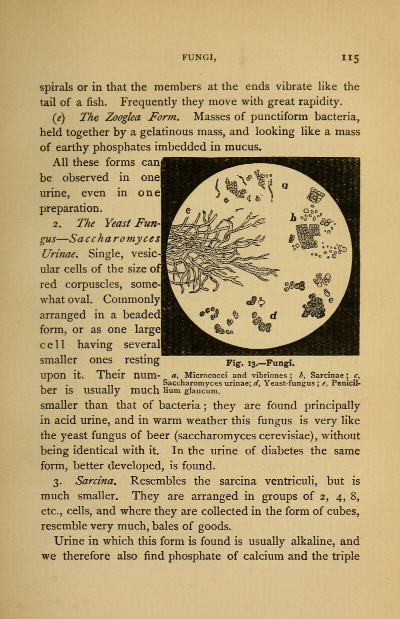 spirals or in that the members at the ends vibrate like the tail of a fish. Frequently they move with great rapidity. {e) The Zooglea Form. Masses of punctiform bacteria, held together by a gelatinous mass, and looking like a mass of earthy phosphates imbedded in mucus. All these forms canj be observed in one] urine, even in onej preparation. 2. The Yeast FunA gus—Saccharomyces\ Urinae, Single, vesic- ular cells of the size of red corpuscles, some- what oval. Commonlyl arranged in a beaded! form, or as one large! cell having several! smaller ones resting upon it. Their num- «, Micrococci and vibriones; h, Sarcinae; c, , . ,, , Saccharomyces urinae; d. Yeast-fungus; e, Penicil- ber IS usually much Hum glaucum. smaller than that of bacteria; they are found principally in acid urine, and in warm weather this fungus is very like the yeast fungus of beer (saccharomyces cerevisiae), without being identical with it. In the urine of diabetes the same form, better developed, is found. 3. Sarcina, Resembles the sarcina ventriculi, but is much smaller. They are arranged in groups of 2, 4, 8, etc., cells, and where they are collected in the form of cubes, resemble very much, bales of goods. Urine in which this form is found is usually alkaline, and we therefore also find phosphate of calcium and the triple